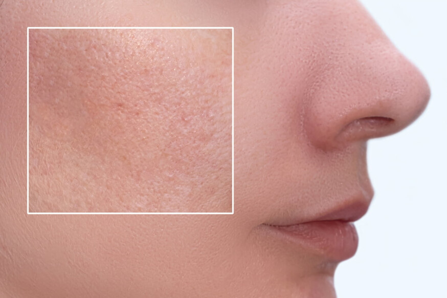 10 Surprising Causes of Clogged Pores on Your Face