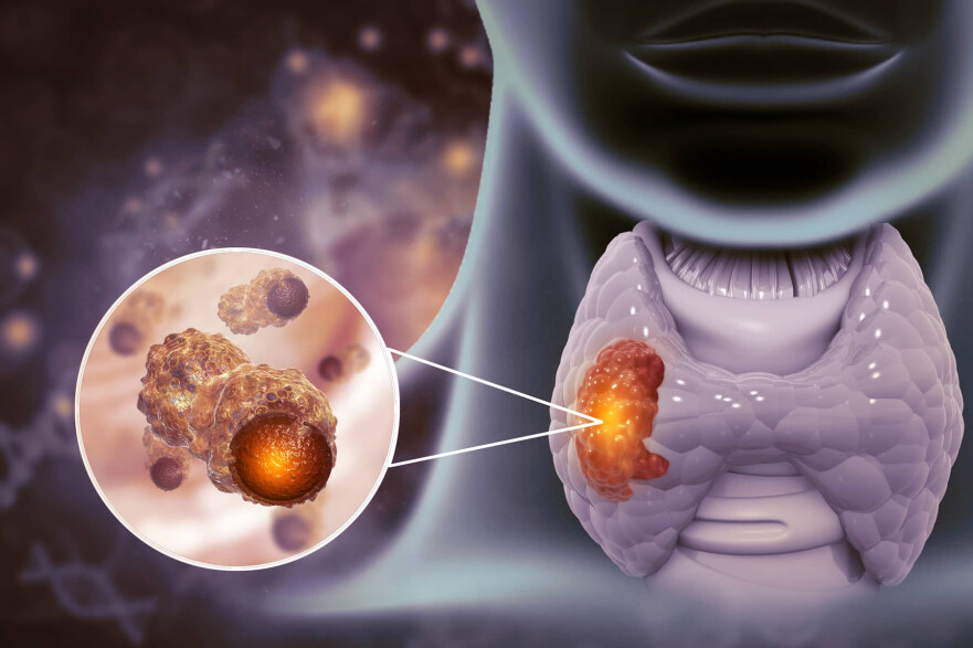 Hyperthyroidism Treatment in Turkey | 2025 Cost and Prices