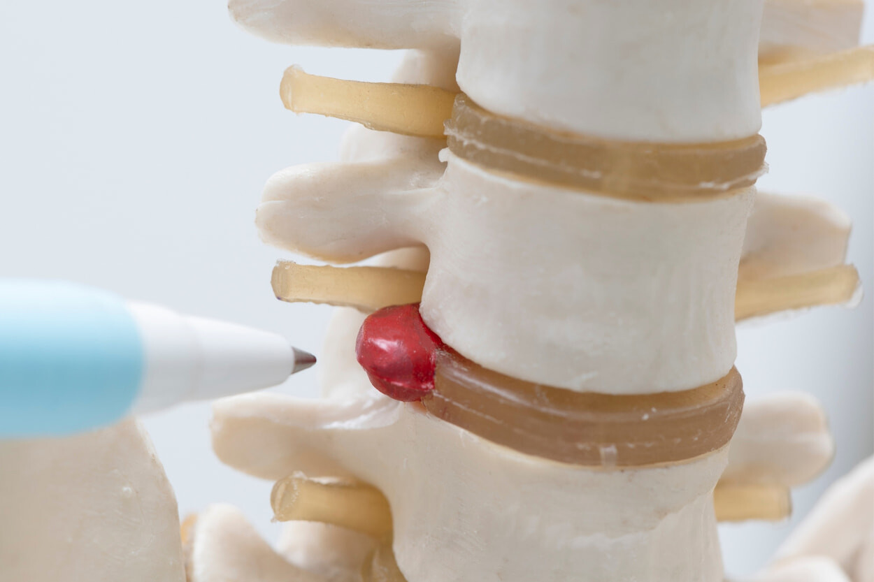 Lumbar Fusion Surgery Cost in Turkey Lumbar Fusion Cost