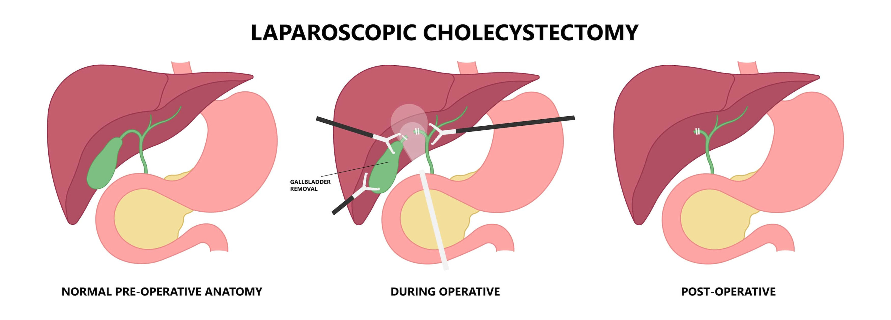 Cholécystectomie laparoscopique en Turquie | Chirurgie générale Turquie