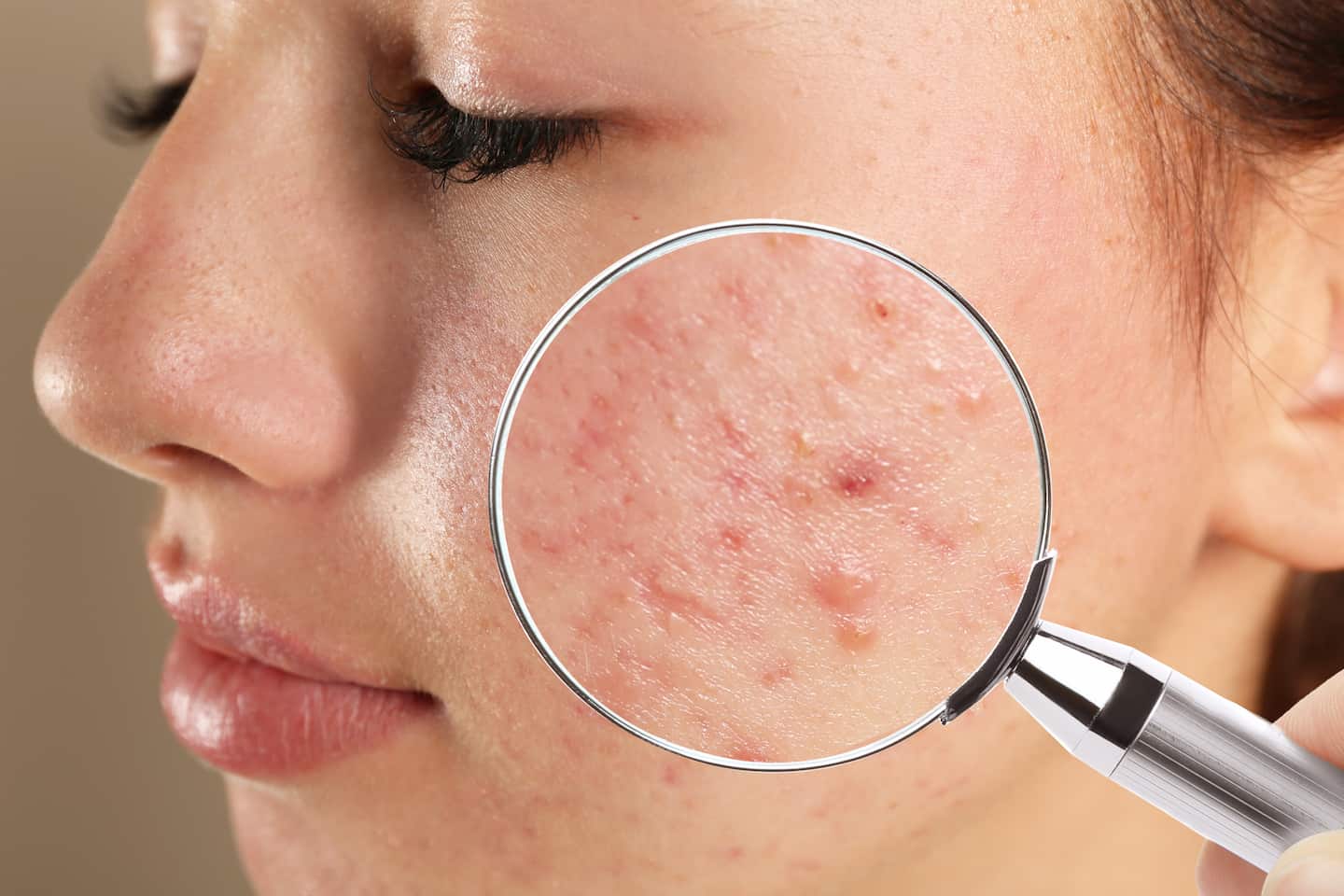 Habits That Could Be Causing Your Acne Flares