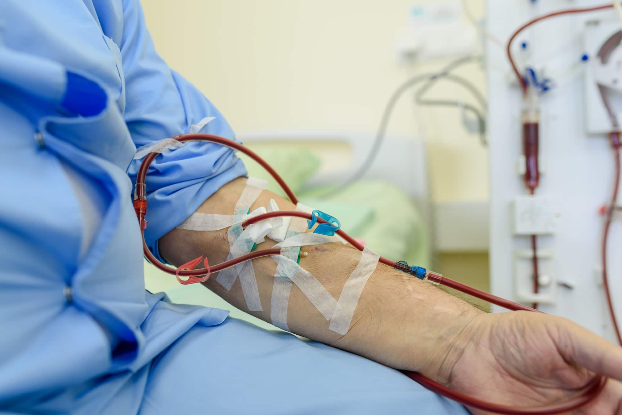 Hemodialysis vs Peritoneal Dialysis