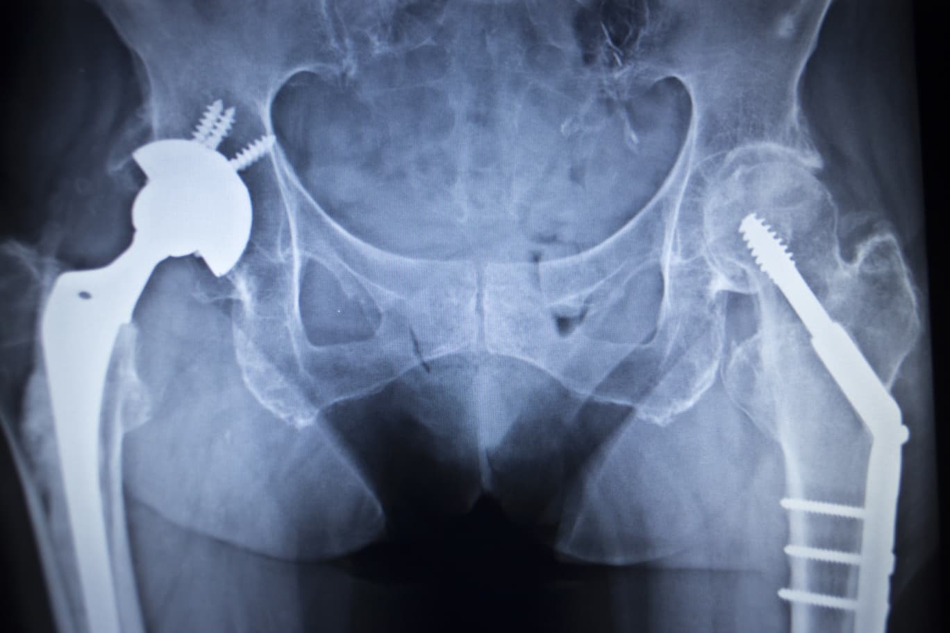 hip replacement options