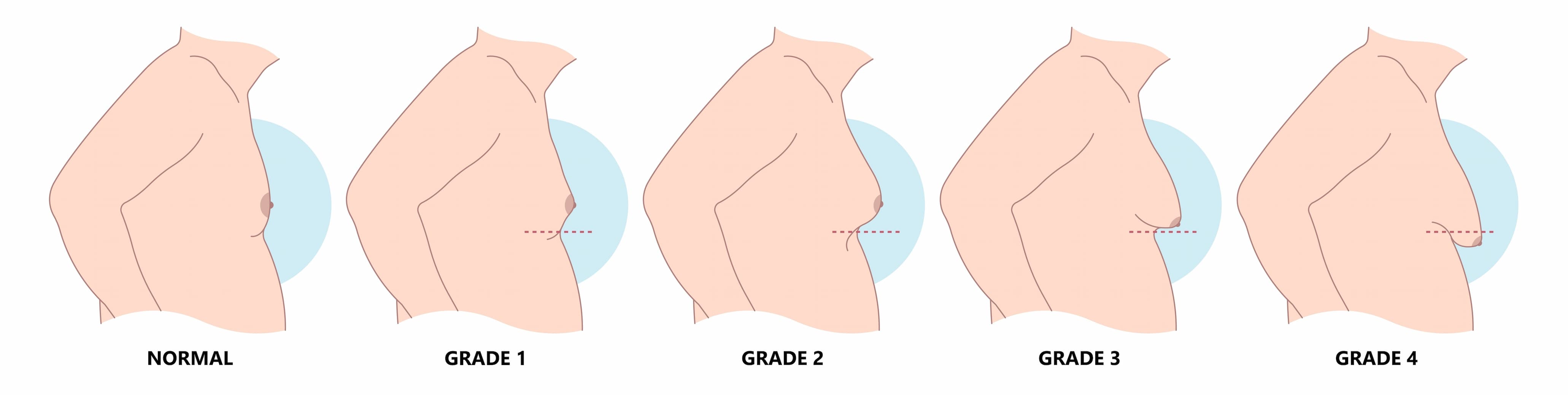 gynecomastia stages