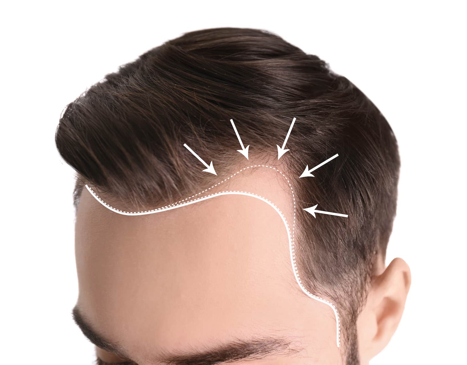 m-shaped-hairline