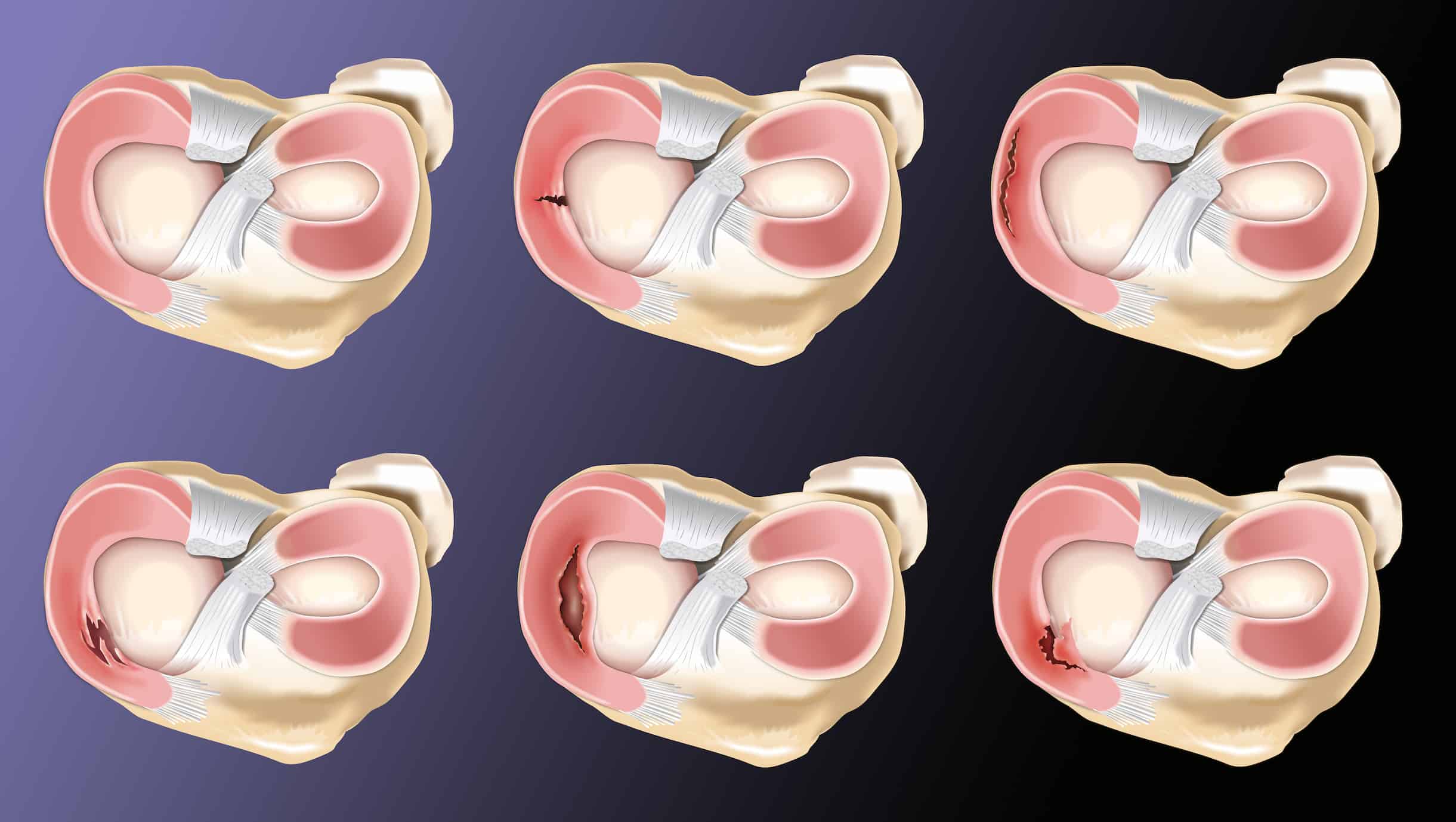 meniscus-repair-vs-meniscectomy