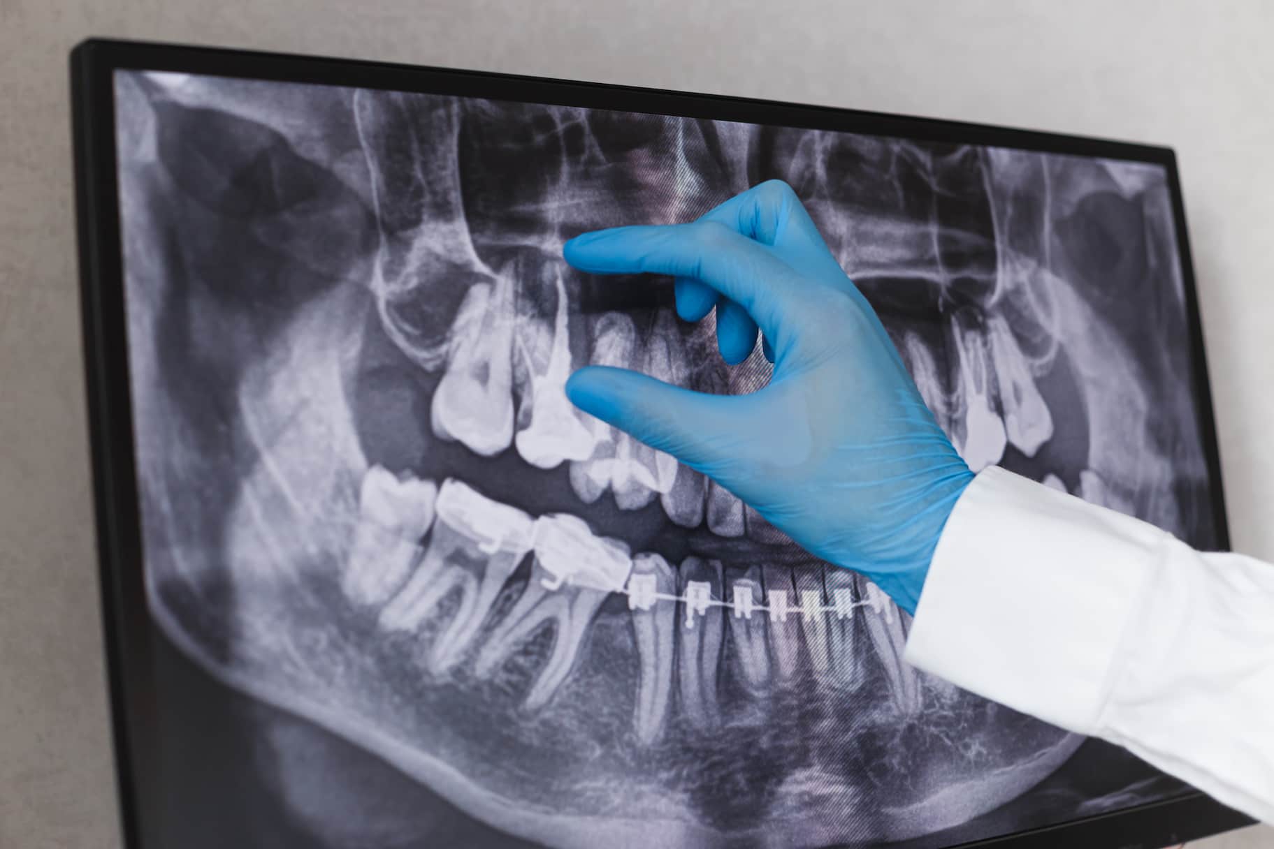 root canal myths debunked separating fact from fiction