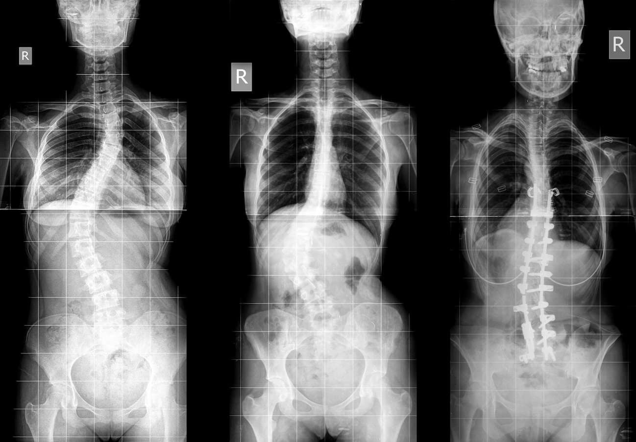 various-types-of-scoliosis