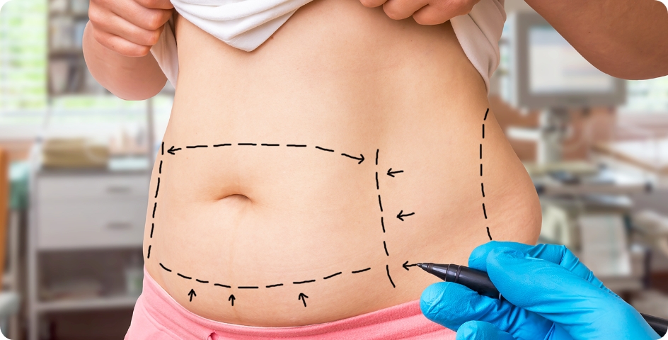 thing to know about tummy tuck