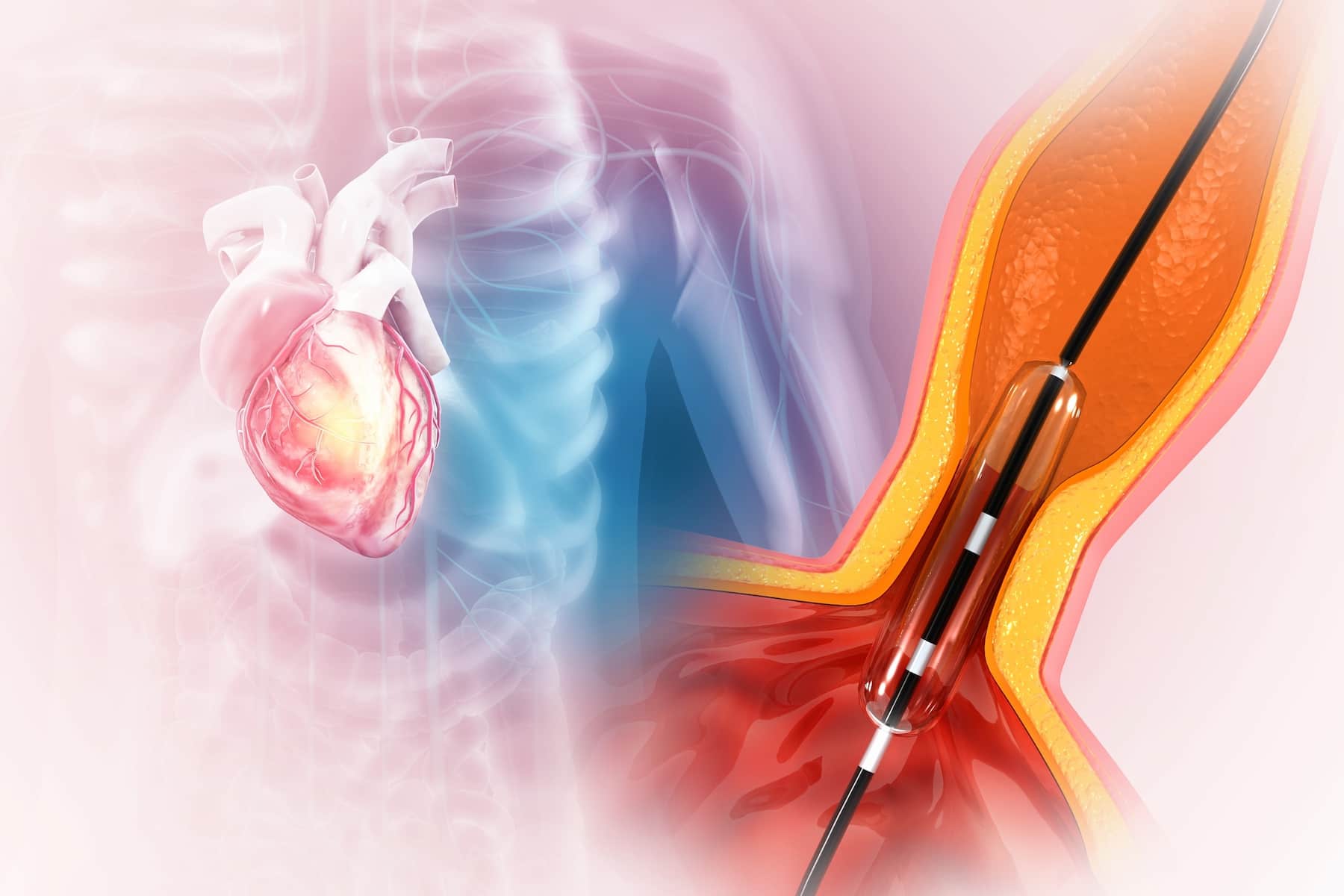 what is interventional cardiology
