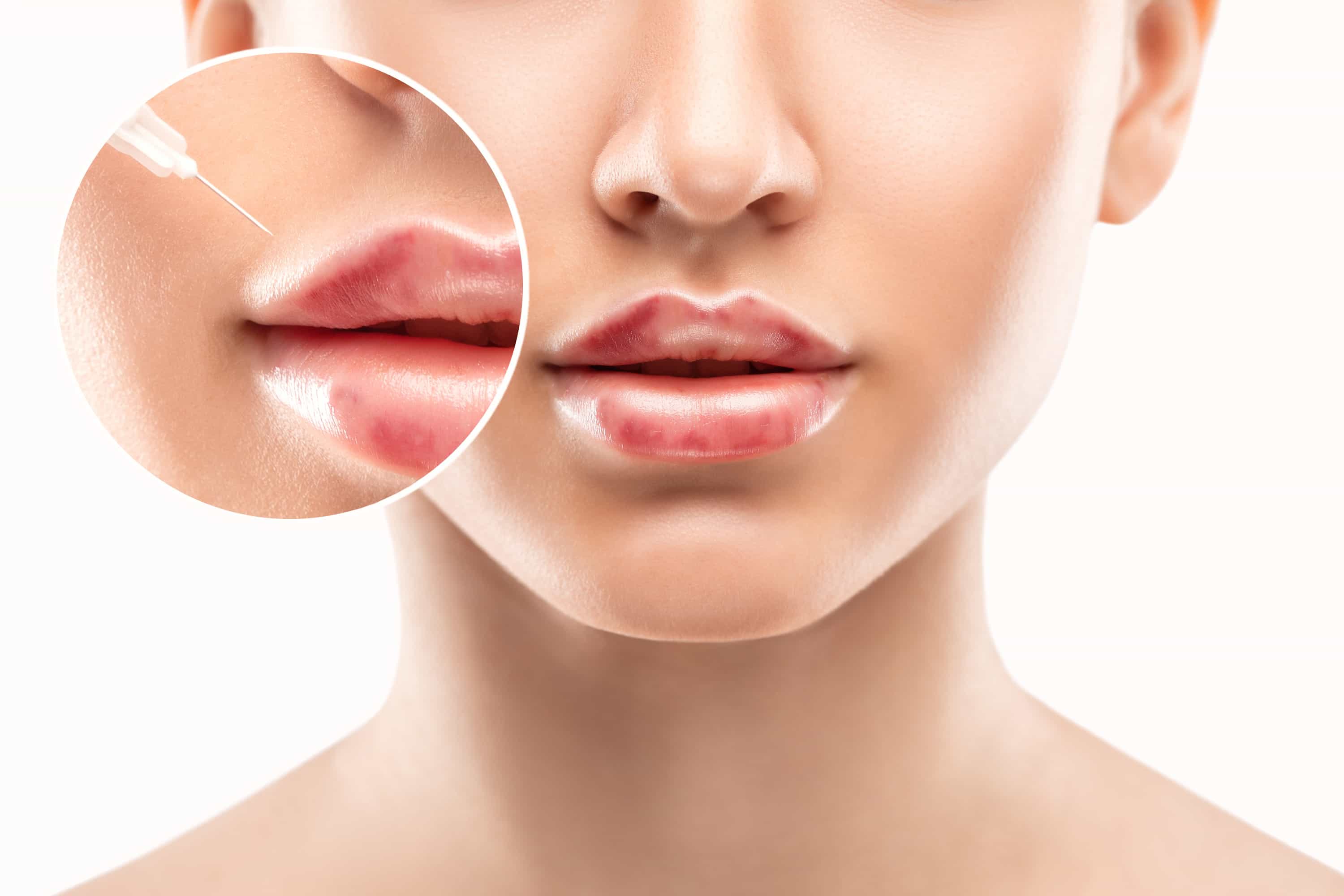 Turkiye lip augmentation procedure