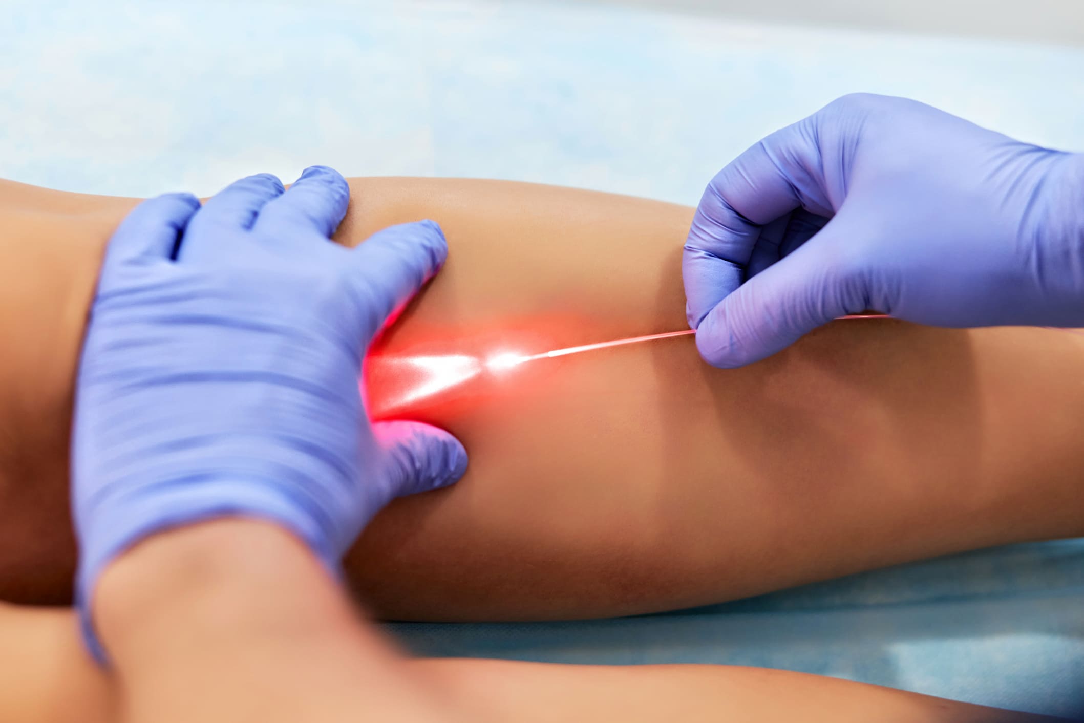 Laser veins memoval treatment turkiye