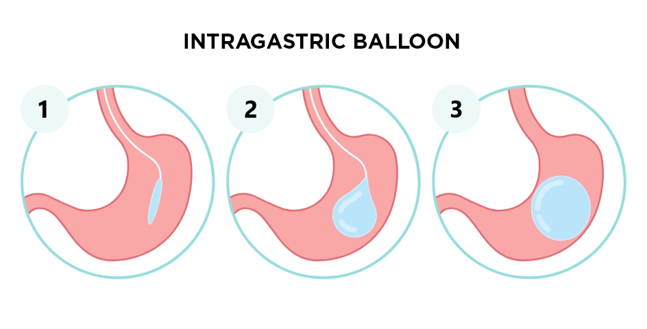 Gastric balloon treatment turkiye