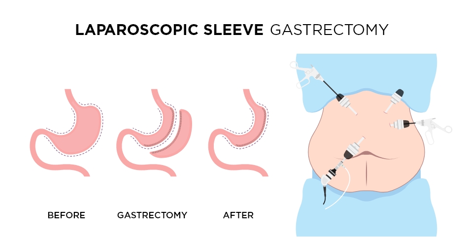 Sleeve gastrectomy in turkiye
