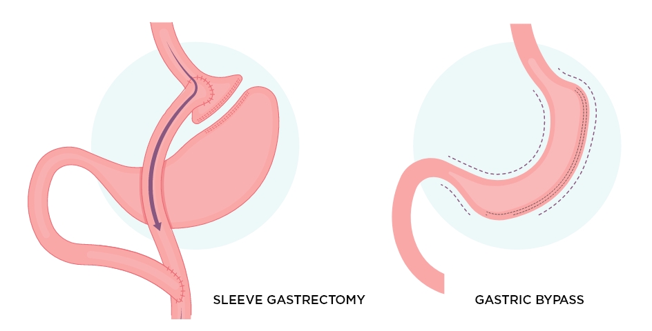 Sleeve gastrectomy surgery turkey
