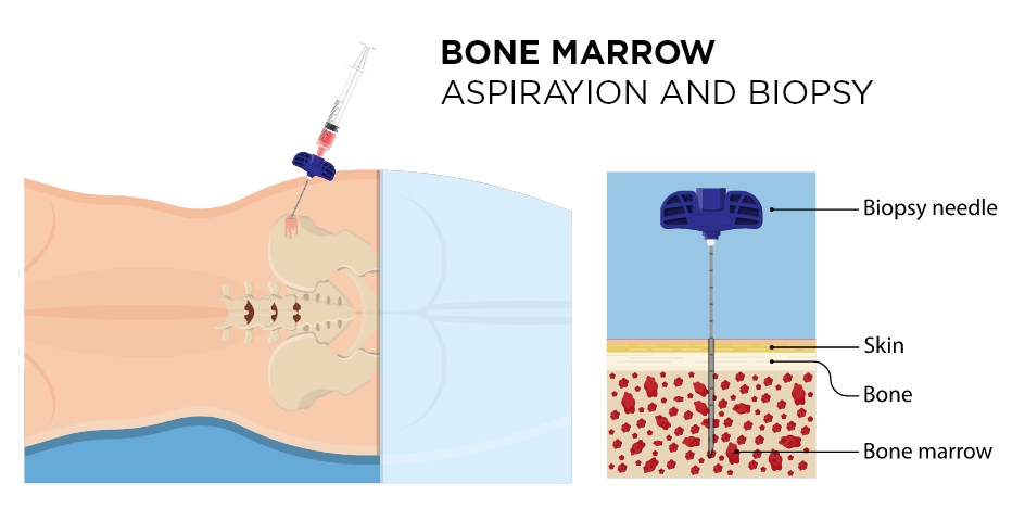Bone marrow transplant in turkiye