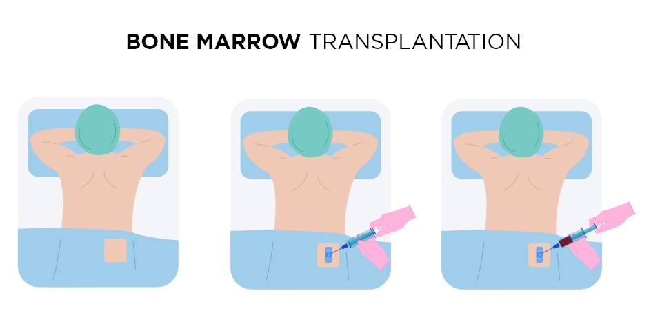 Процедура трансплантации костного мозга в турции