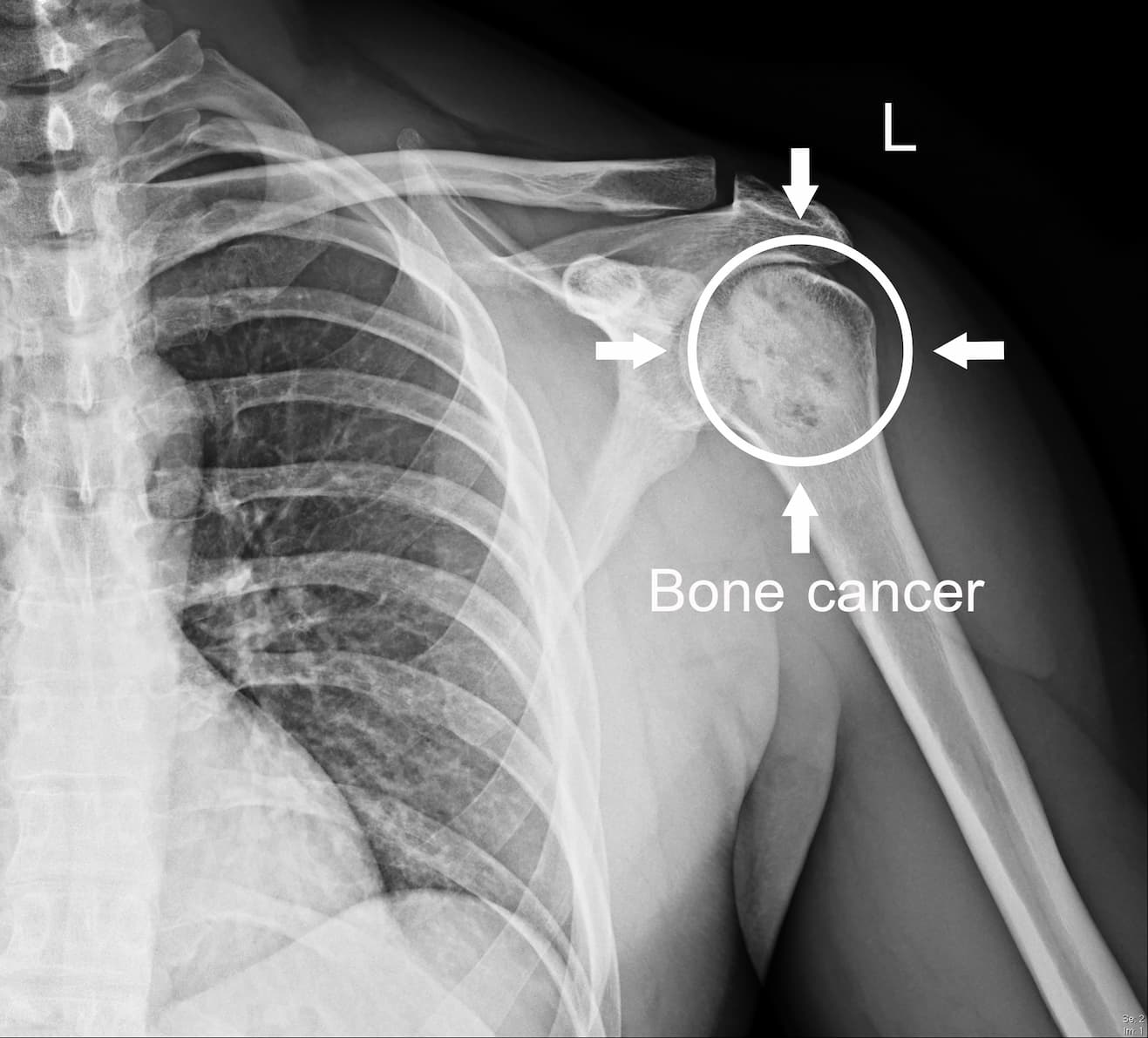 Turkiye bone cancer treatment