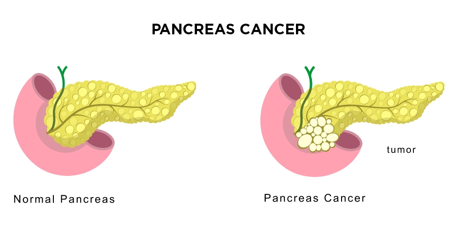 Pancreatic cancer treatment turkey