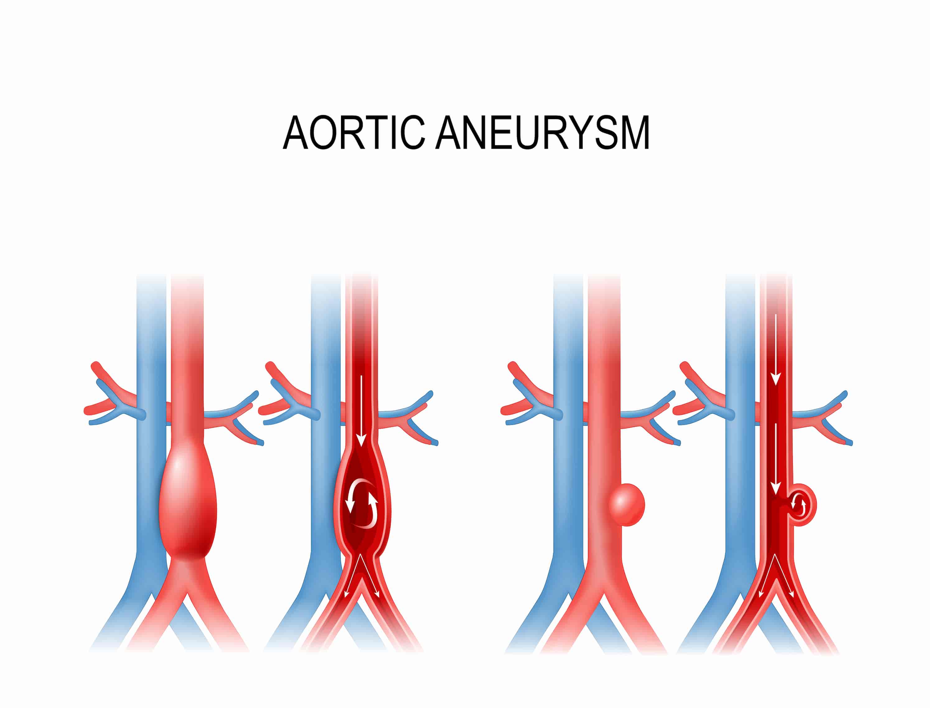 Aortic aneurysm surgery turkiye