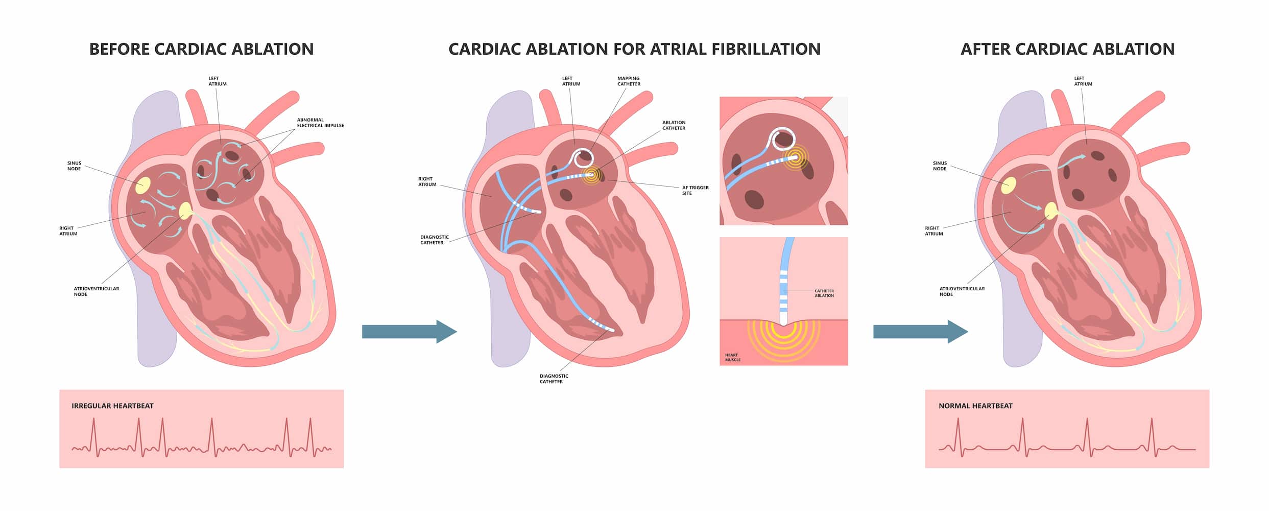 Cardiac ablation treatment turkiye