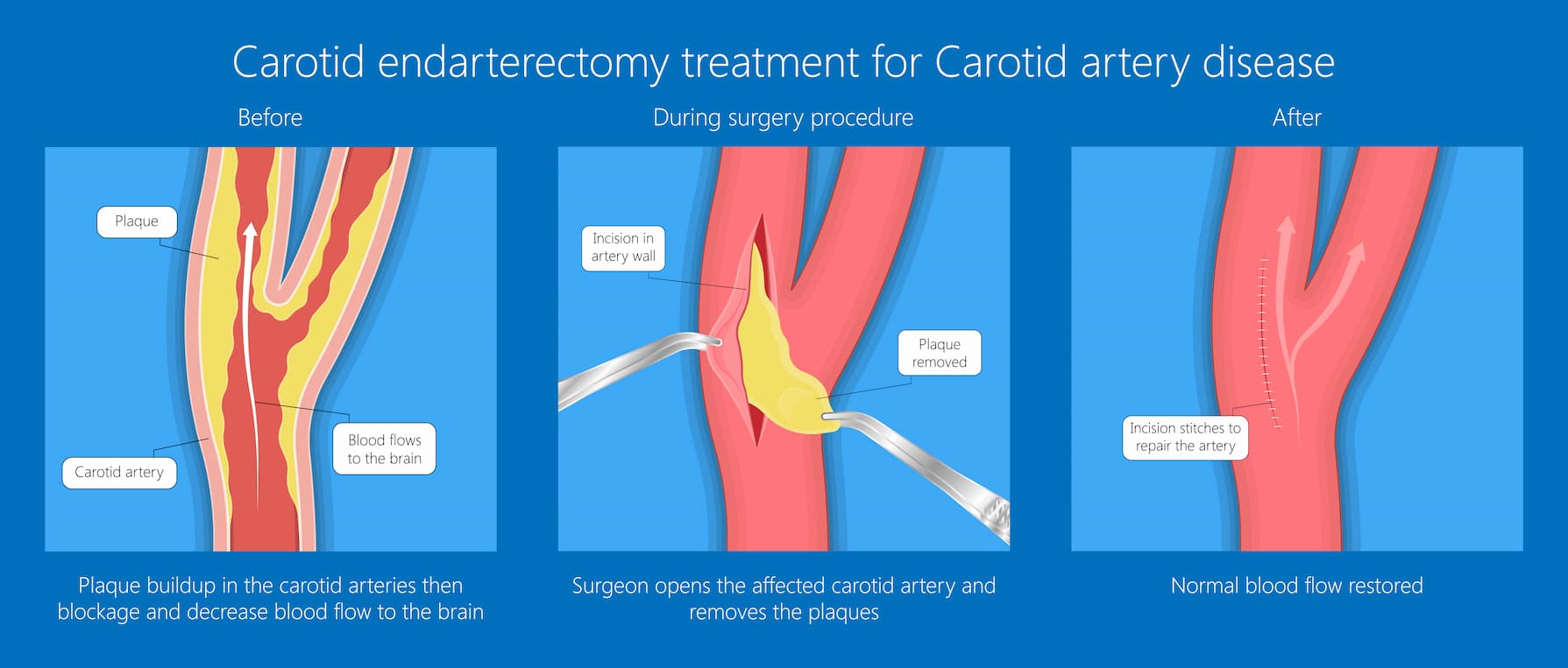 Turkey carotid endarterectomy