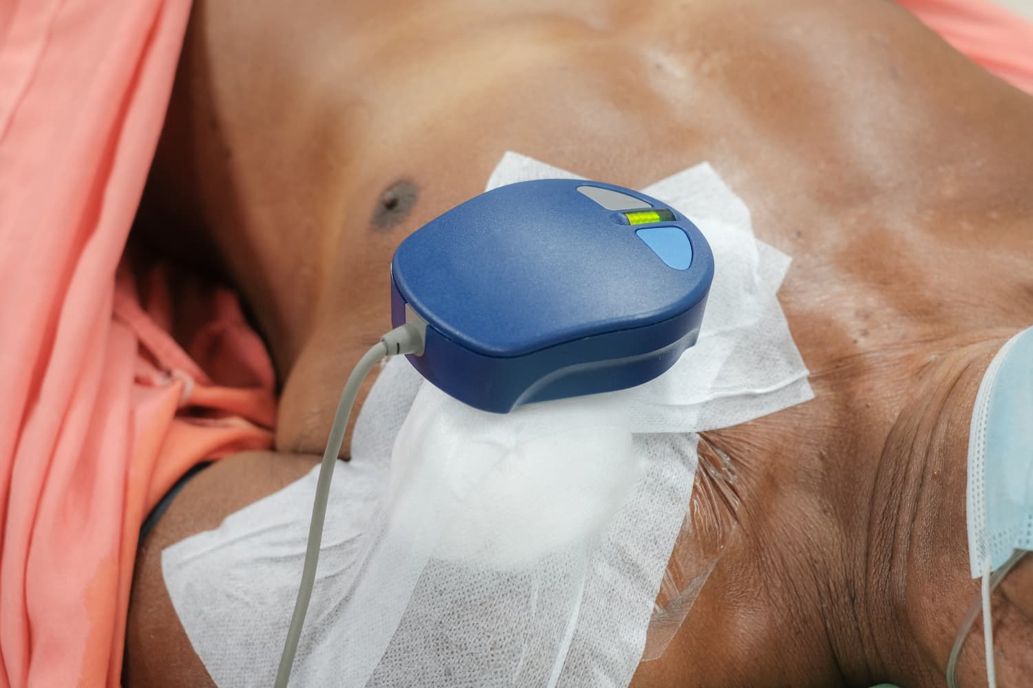 Defibrillator implant surgery turkiye