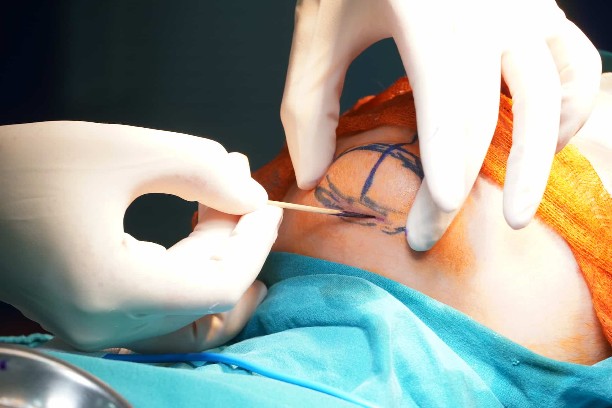 Chirurgie d'augmentation du menton en turquie