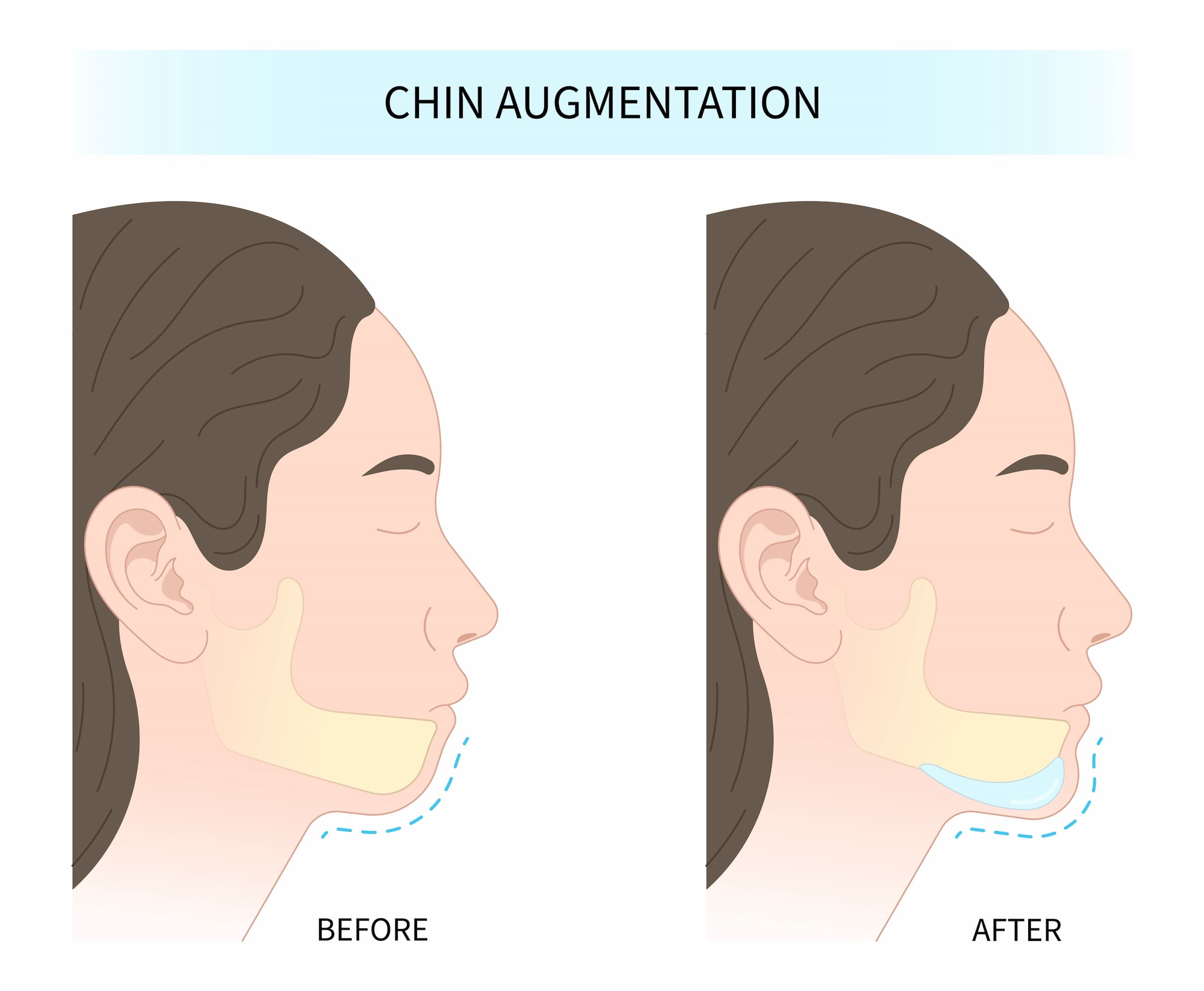 Turkiye chin augmentation surgery