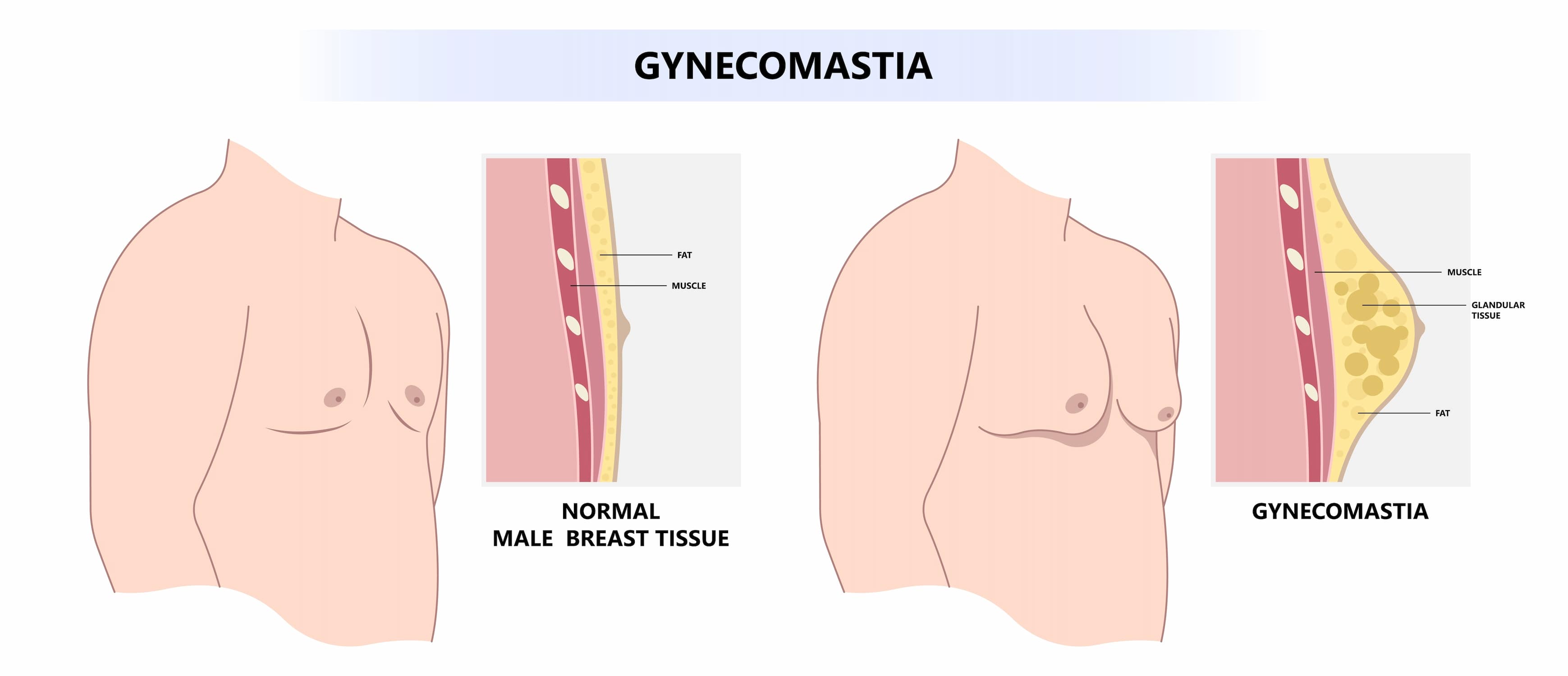 Gynecomastia surgery turkiye