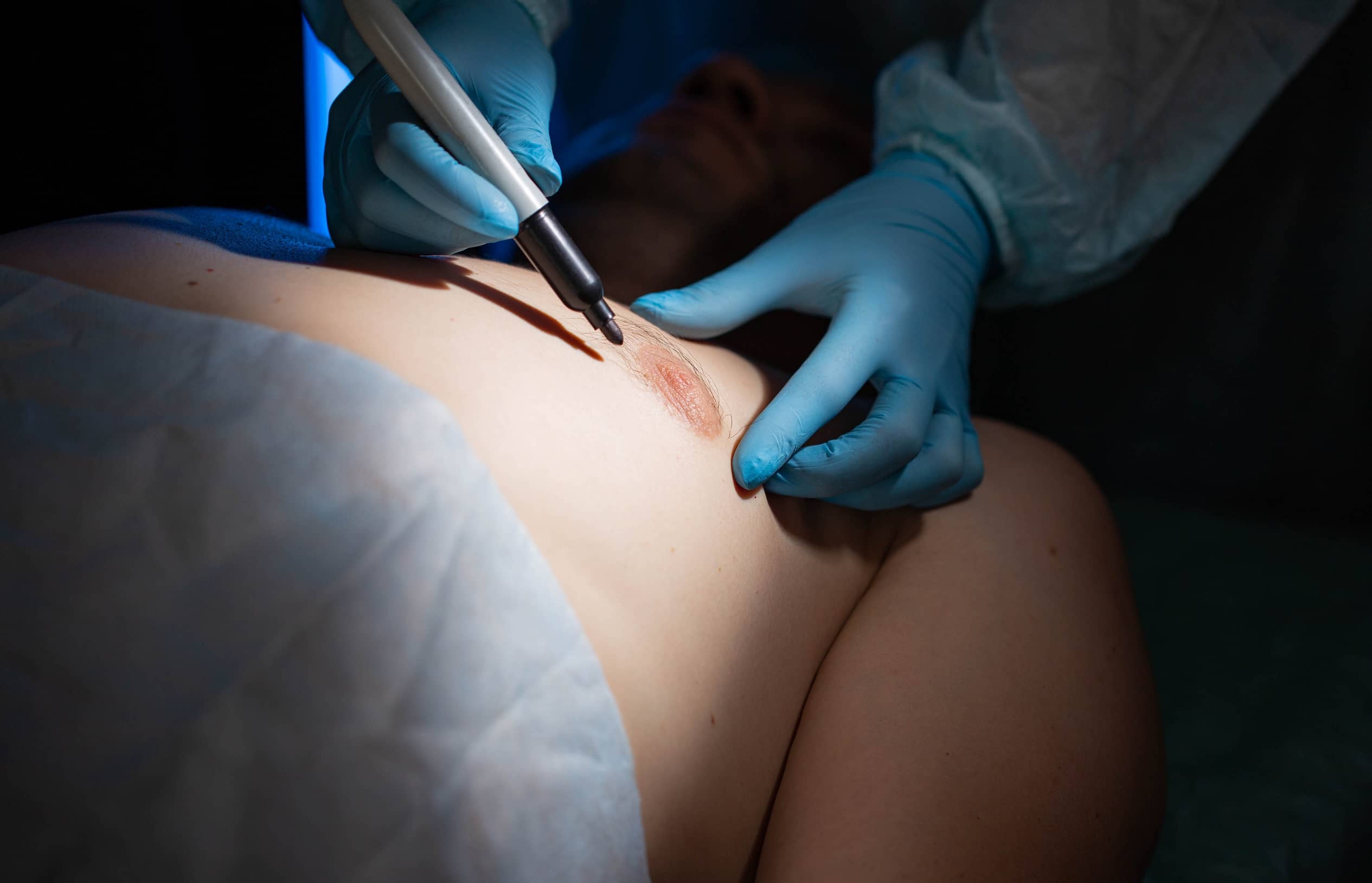 Procédure chirurgicale de gynécomastie turquie