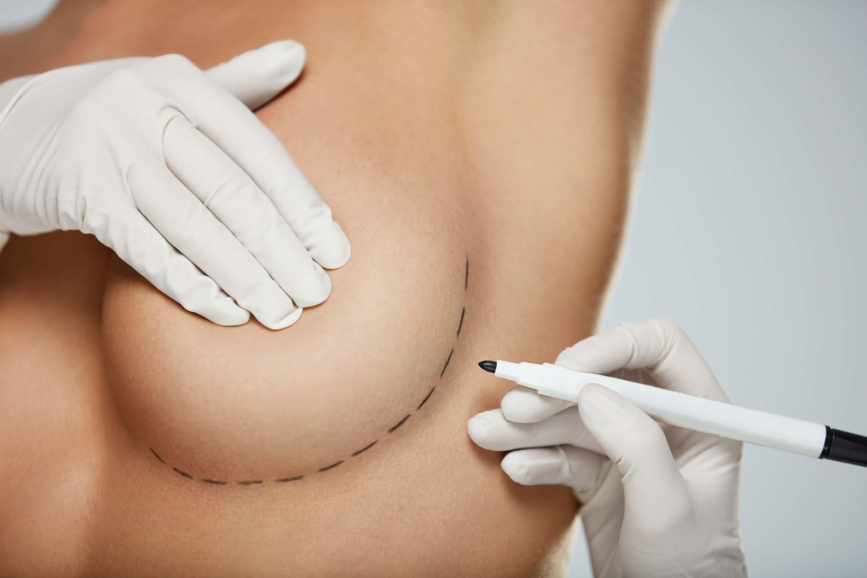 Procedimiento de implantes mamarios turqua