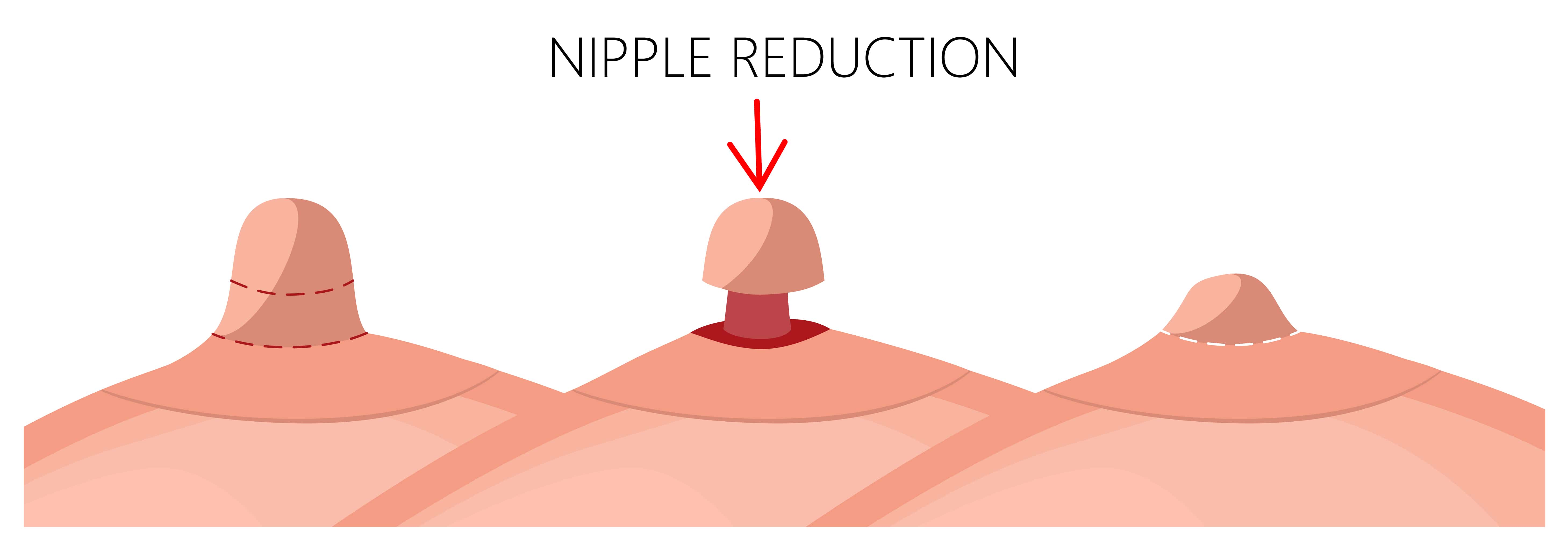 Nipple reduction surgery turkiye