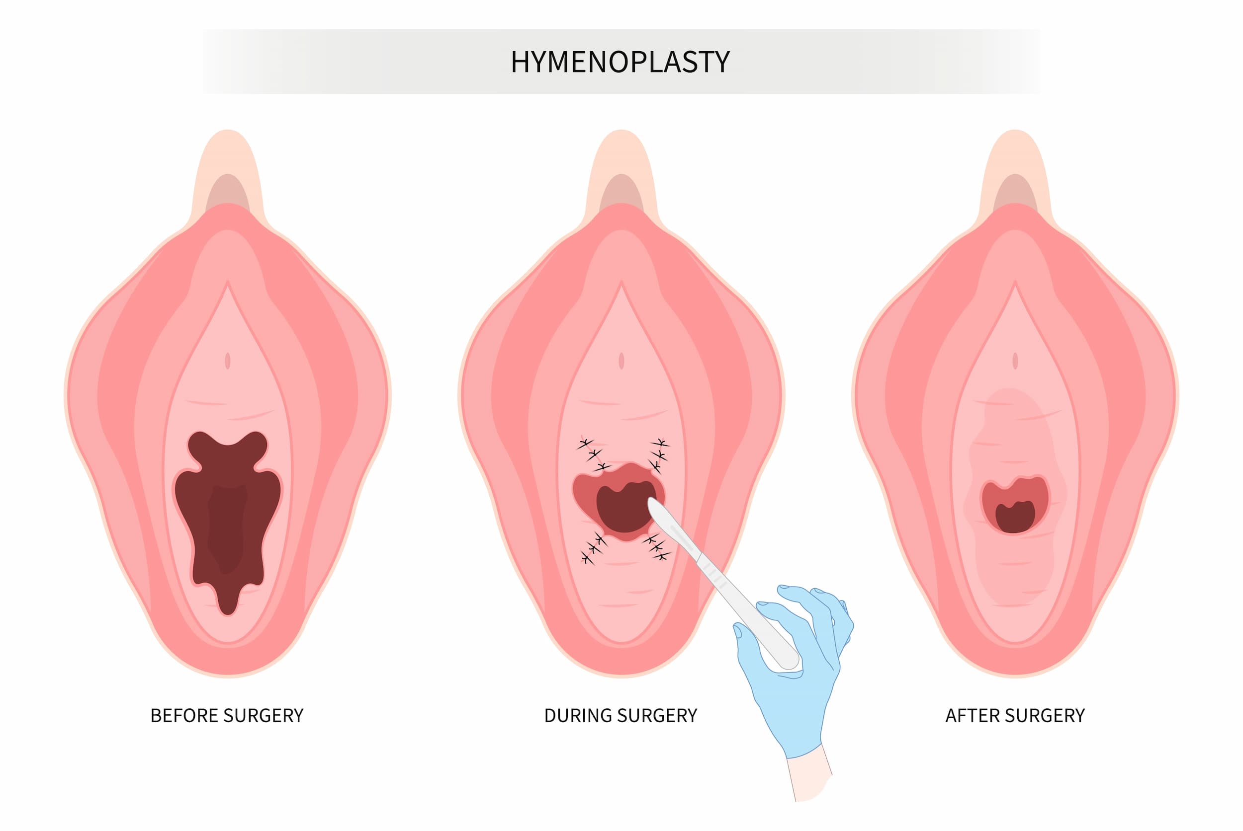 Turkiye hymenoplasty surgery