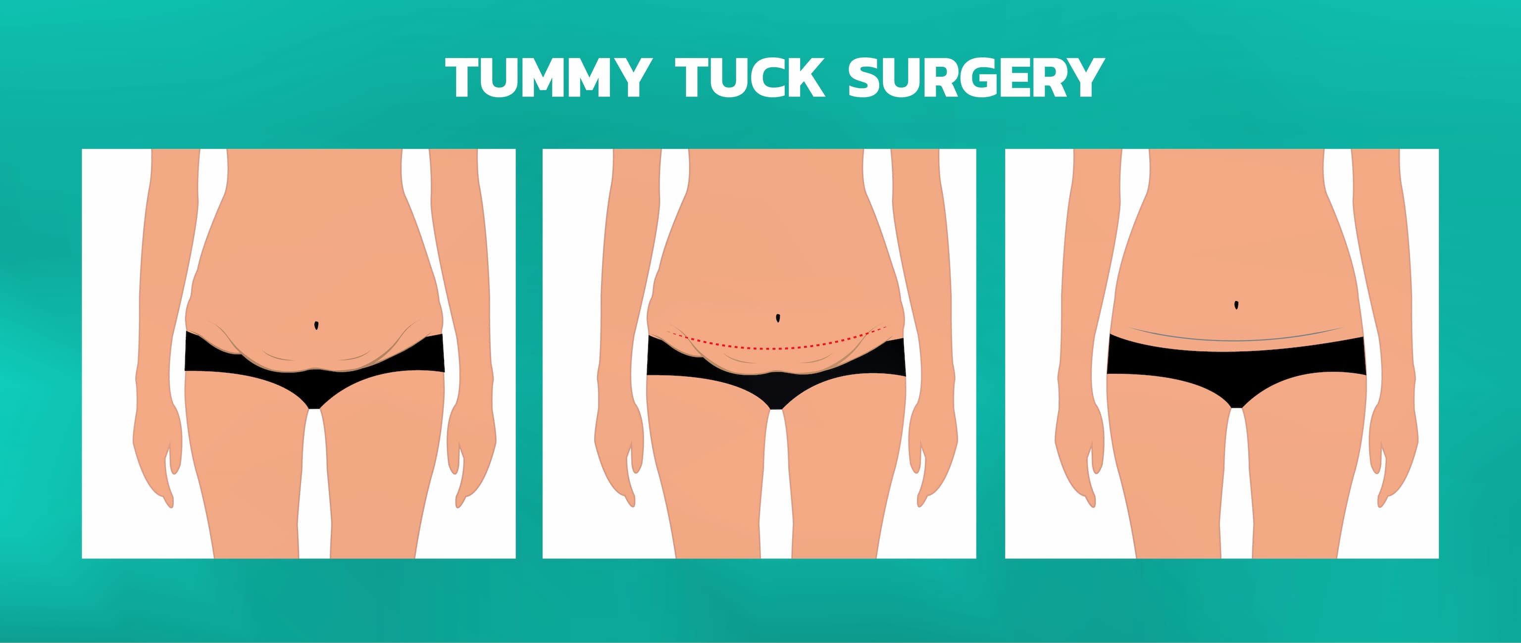 Turkiye tummy tuck surgery