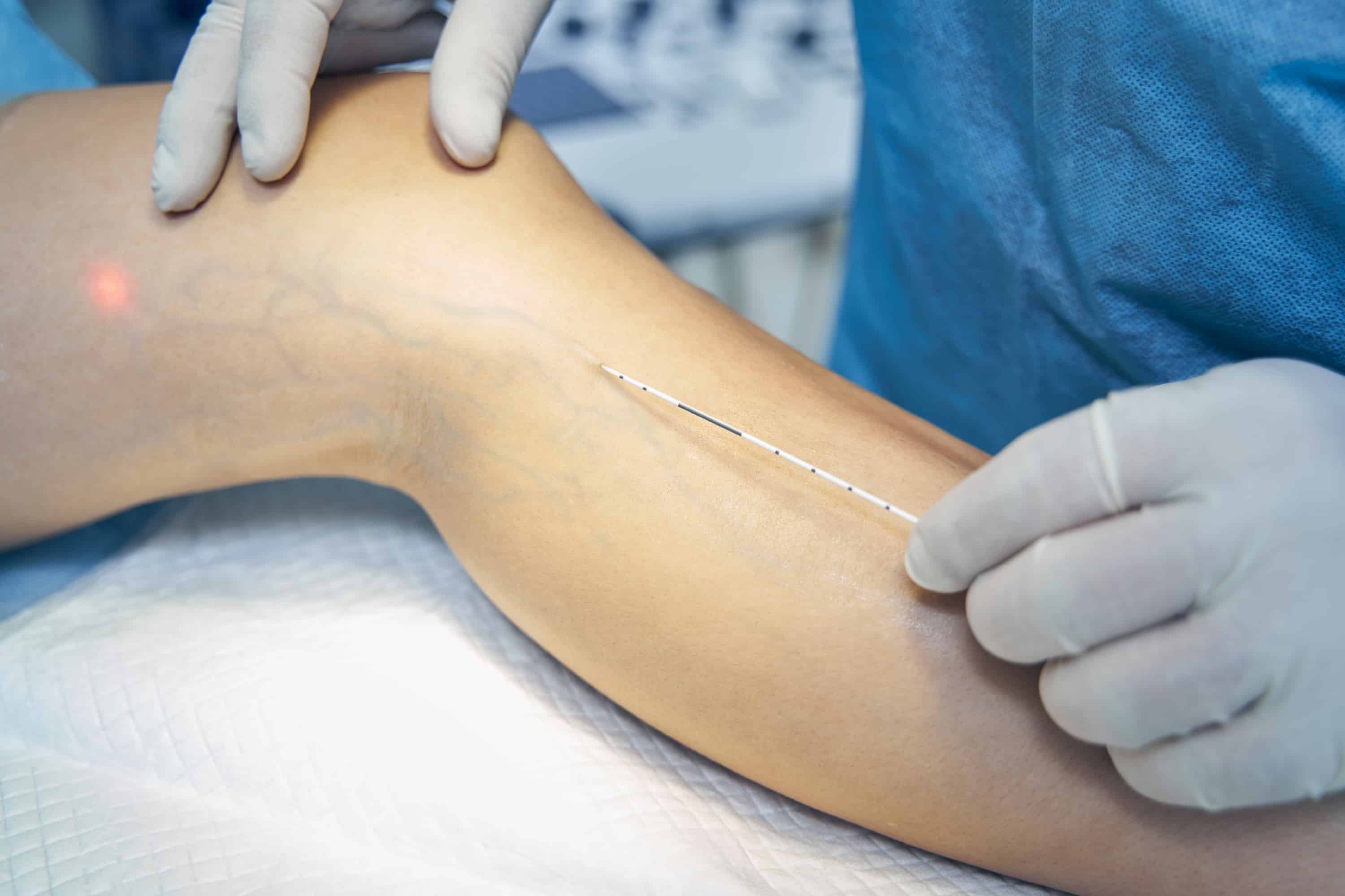 Turkiye varicose vein removal surgery