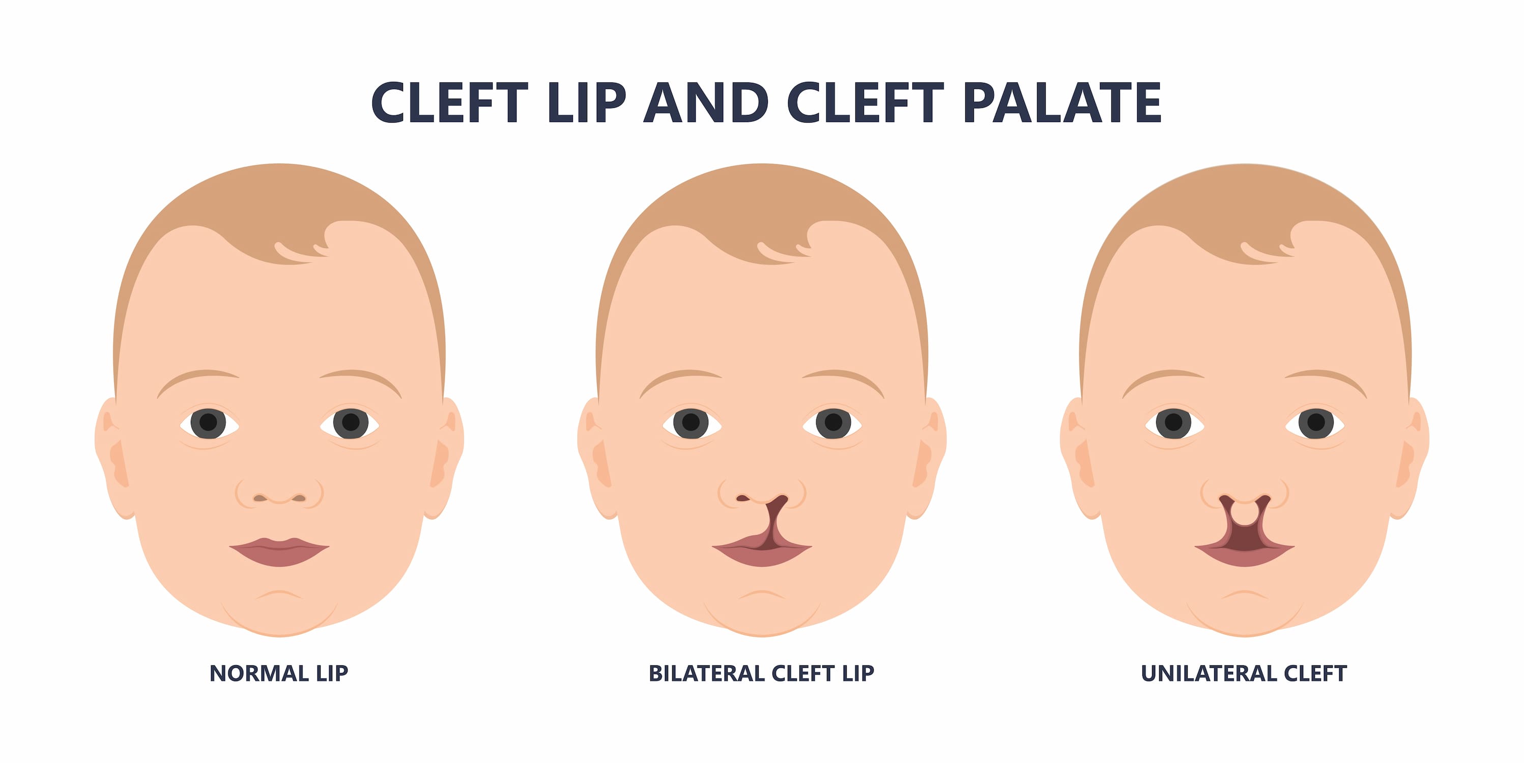 Turkiye cleft lip repair surgery