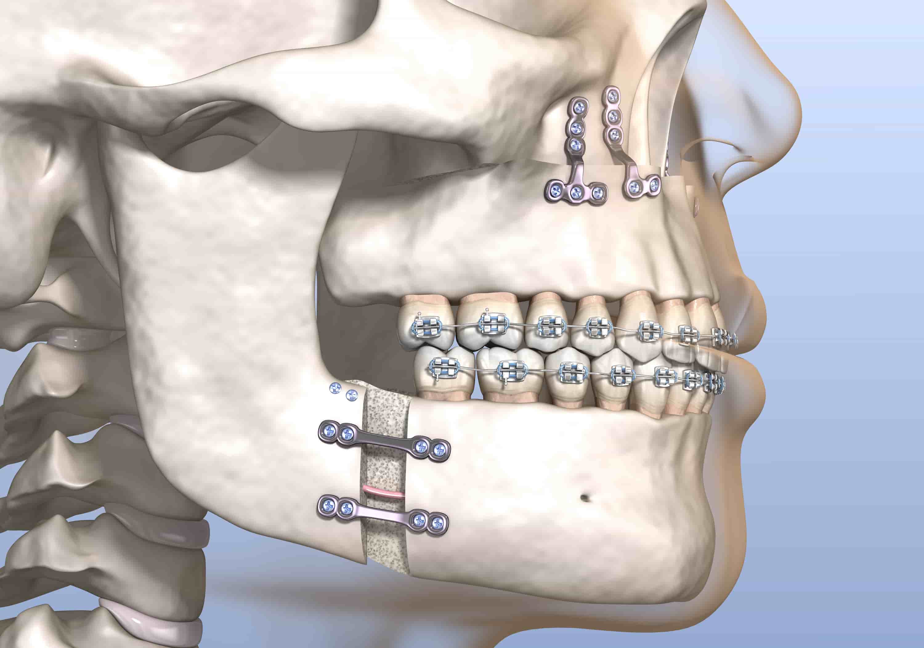 Cirugía de mandíbula de turquía