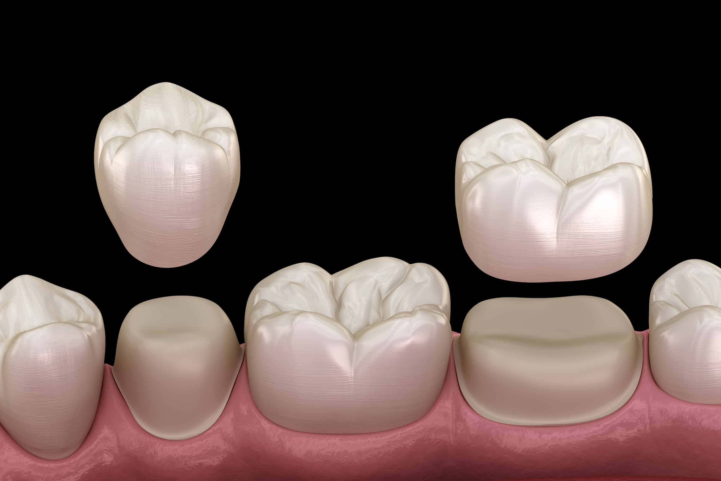 Procedimiento de coronas dentales turquas