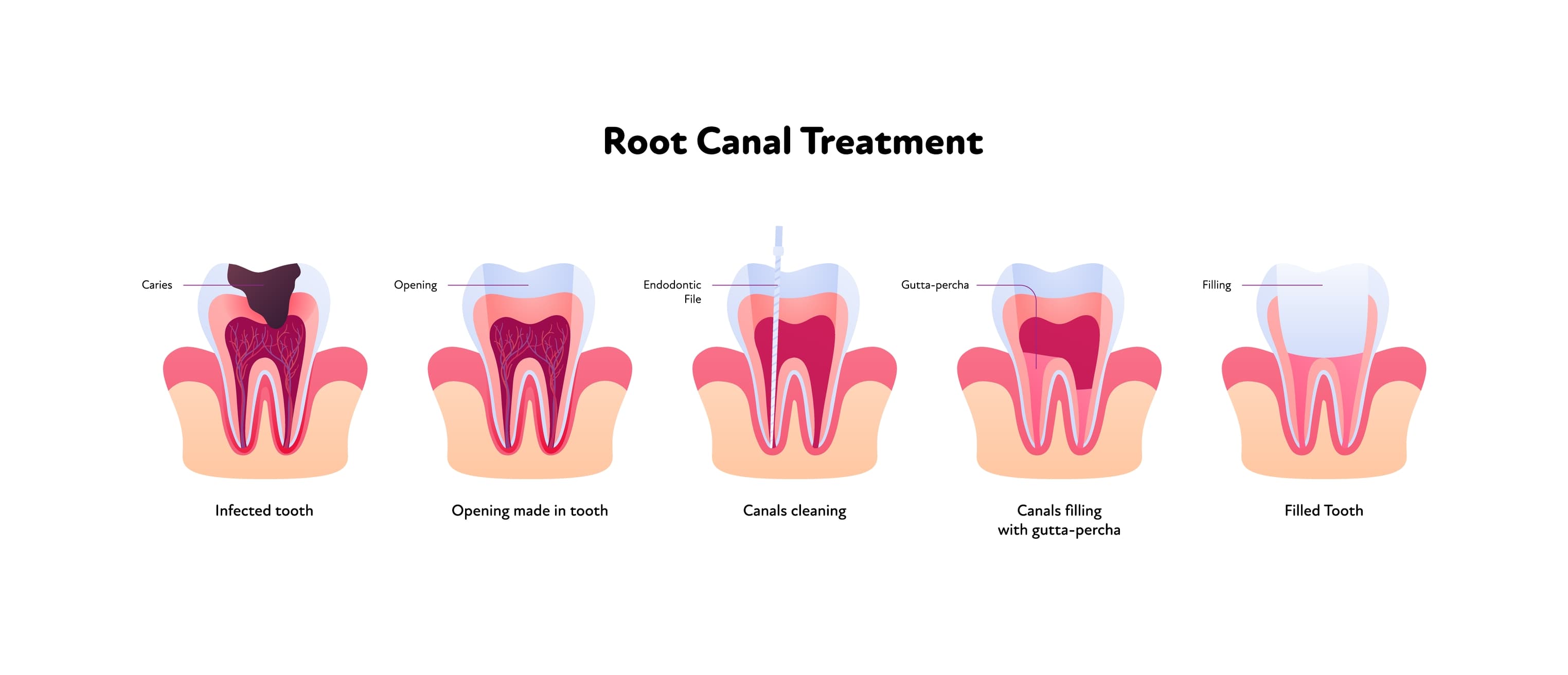 Turkiye root canal treatment