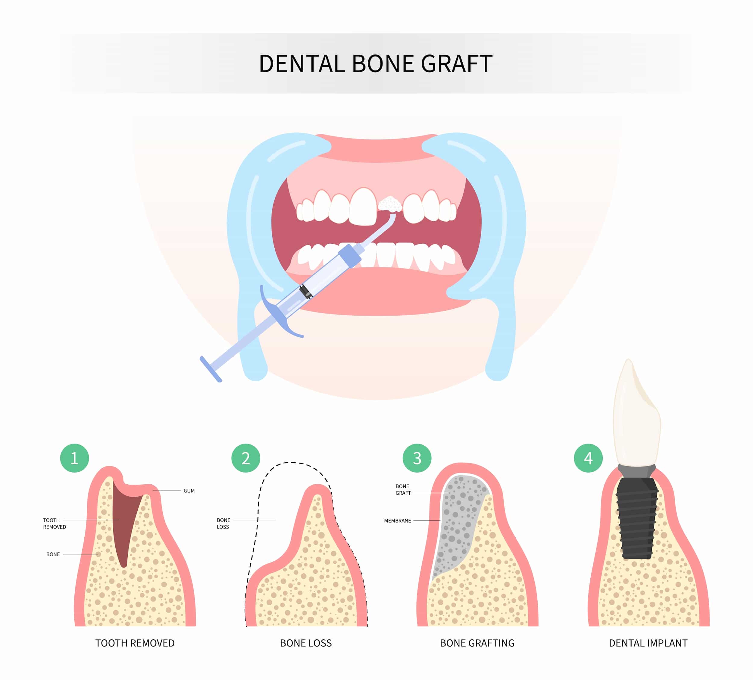 Dental bone graft turkiye