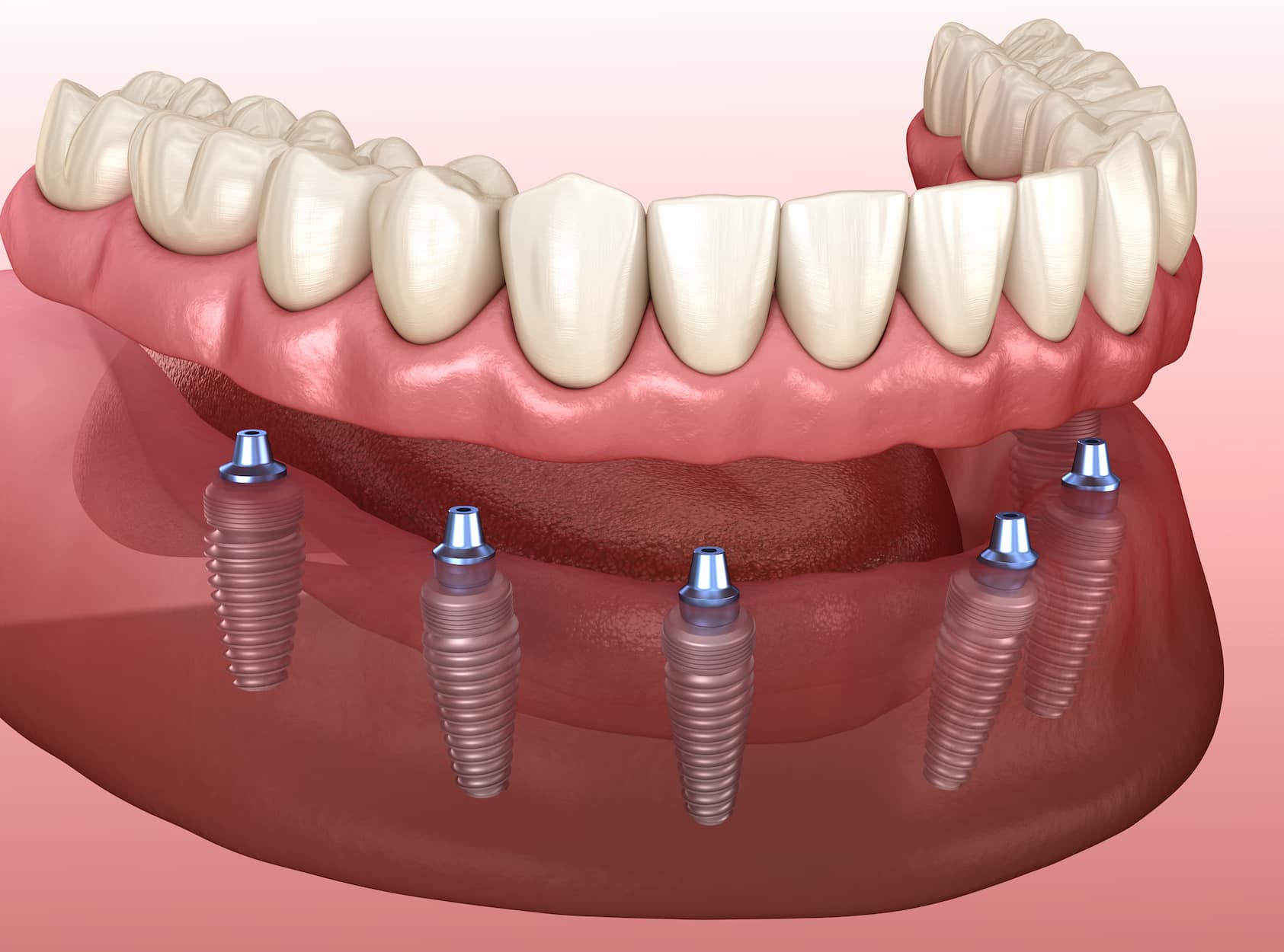 Le tout sur 6 implants dentaires en turquie