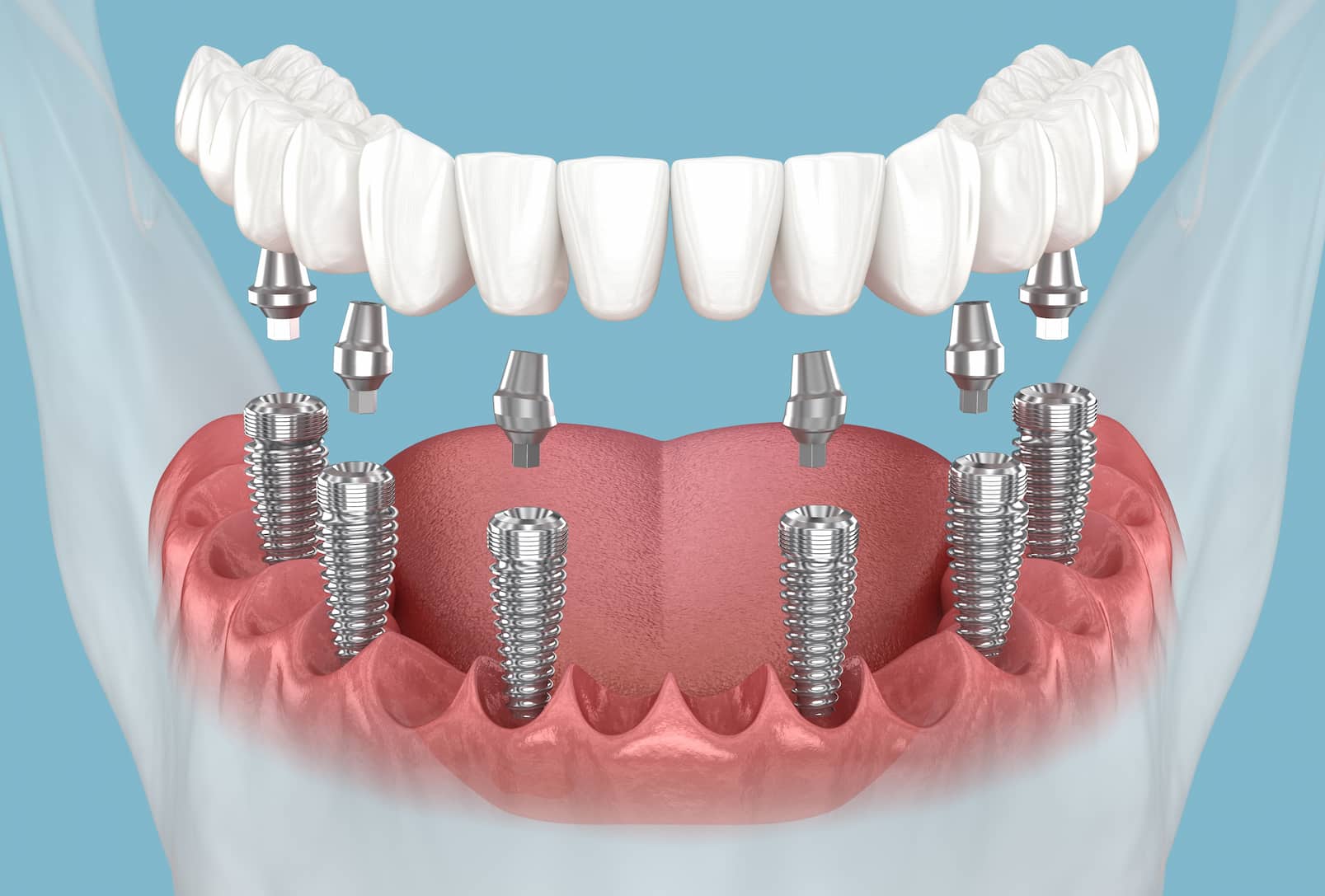 Todo en 6 implantes dentales turqua