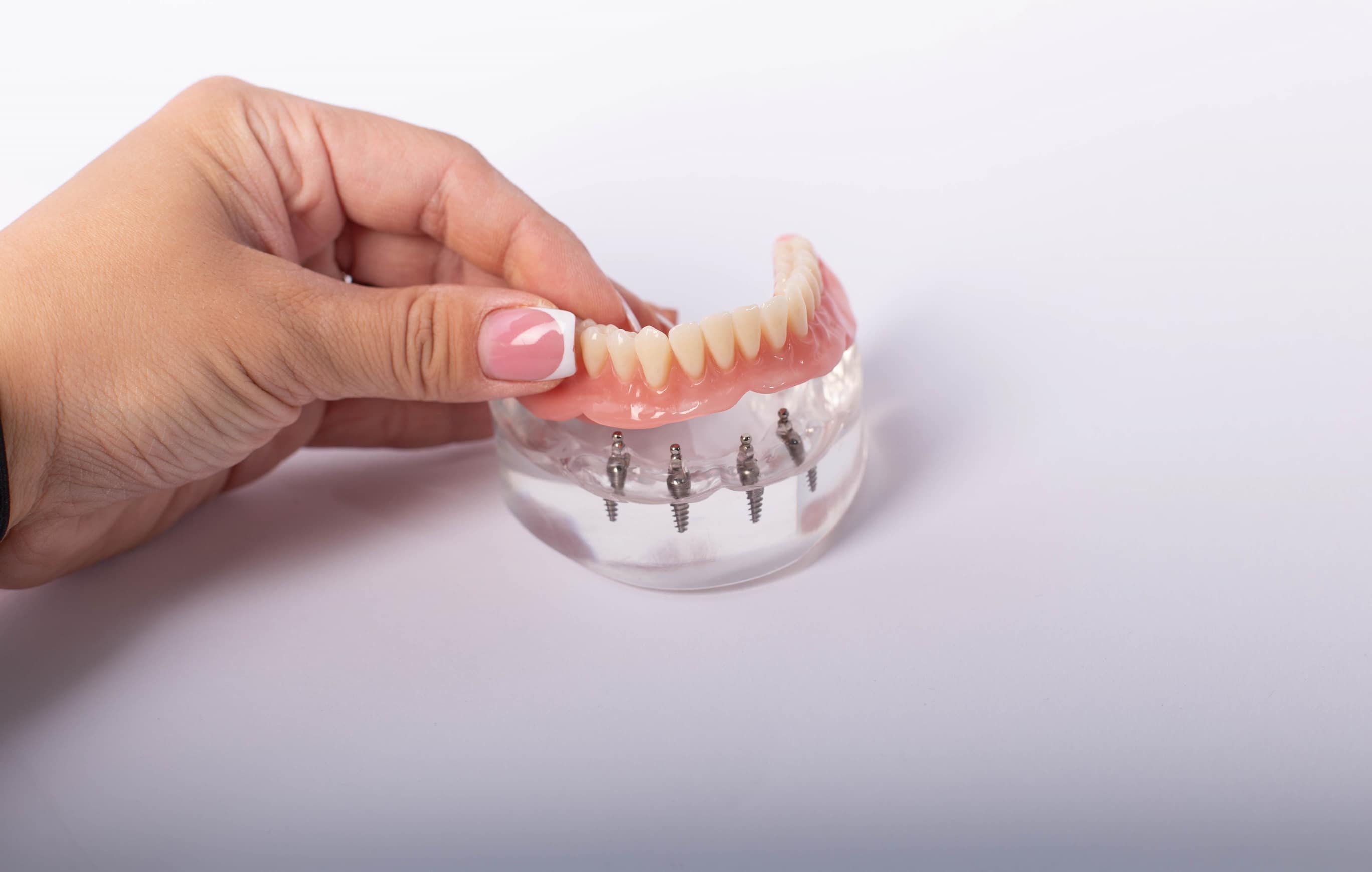 Le tout sur 4 implants dentaires en turquie