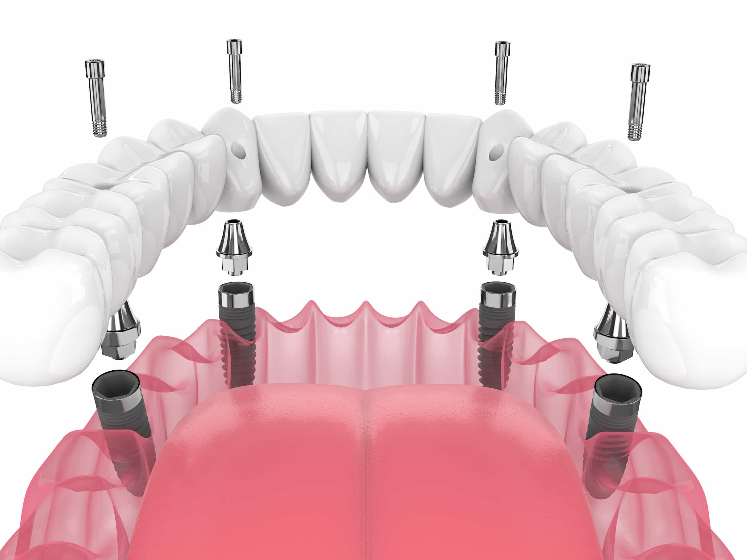 Le tout sur 4 implants dentaires turquie