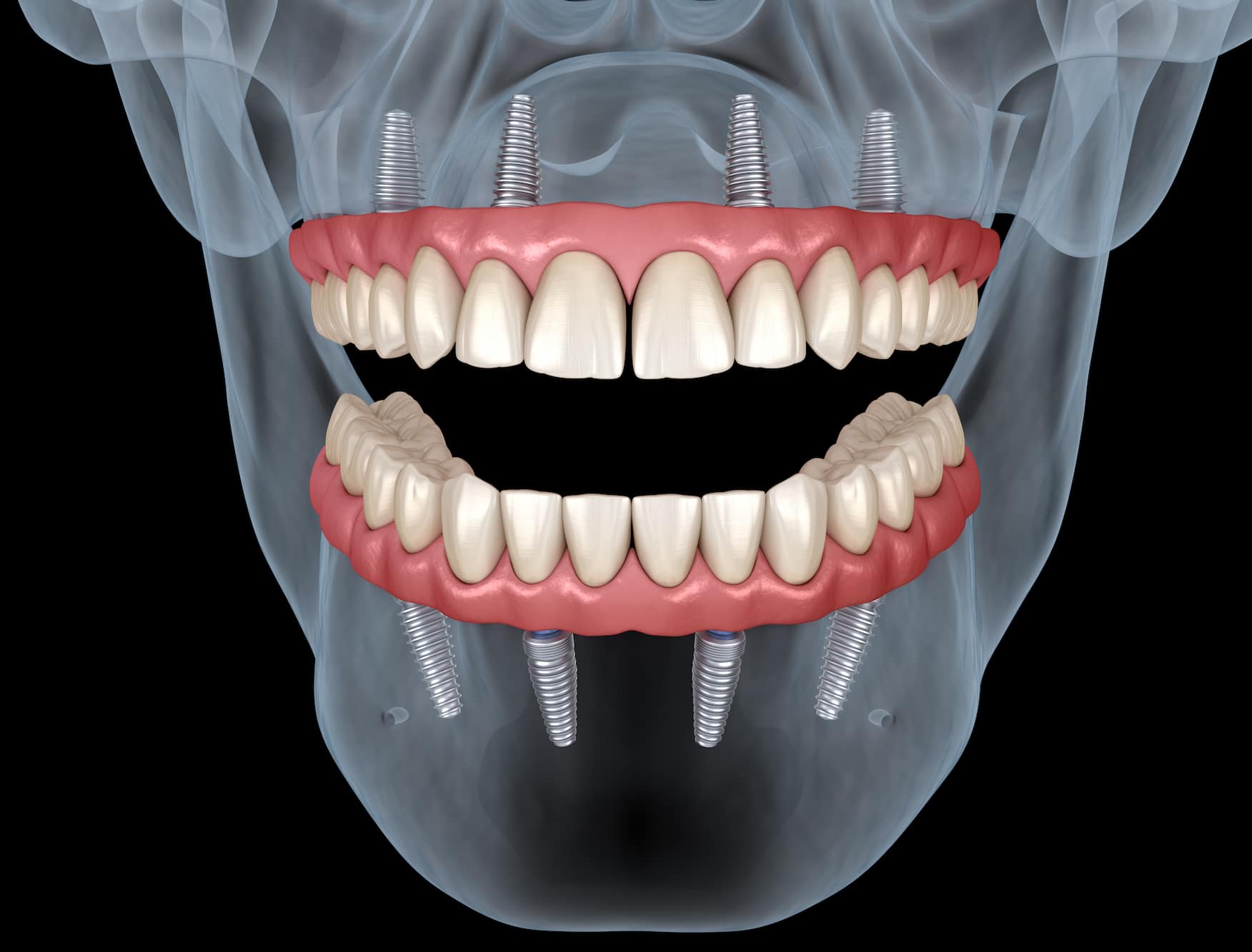 Turqua todo sobre 4 implantes dentales