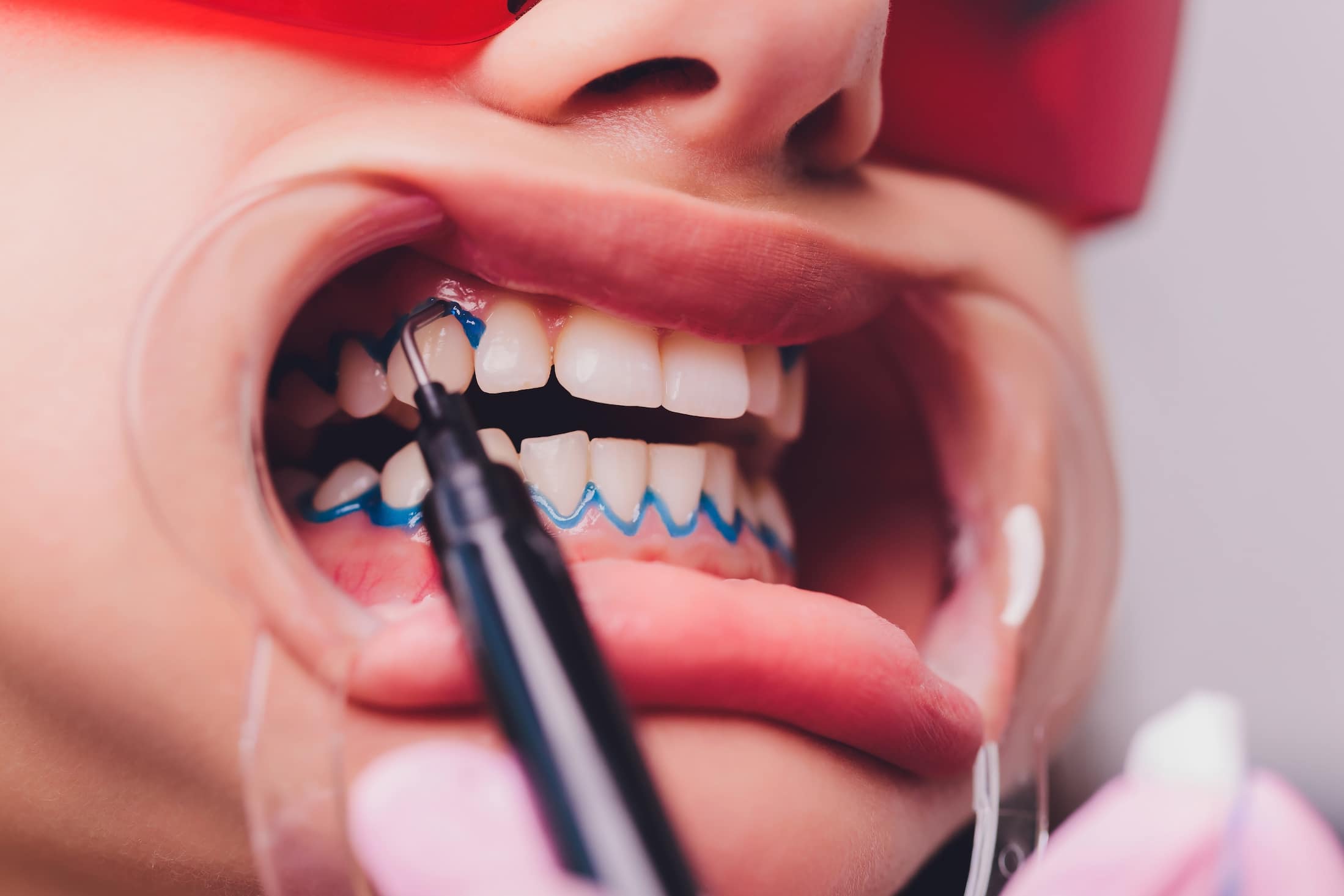 Процедура лазерного отбеливания зубов в турции