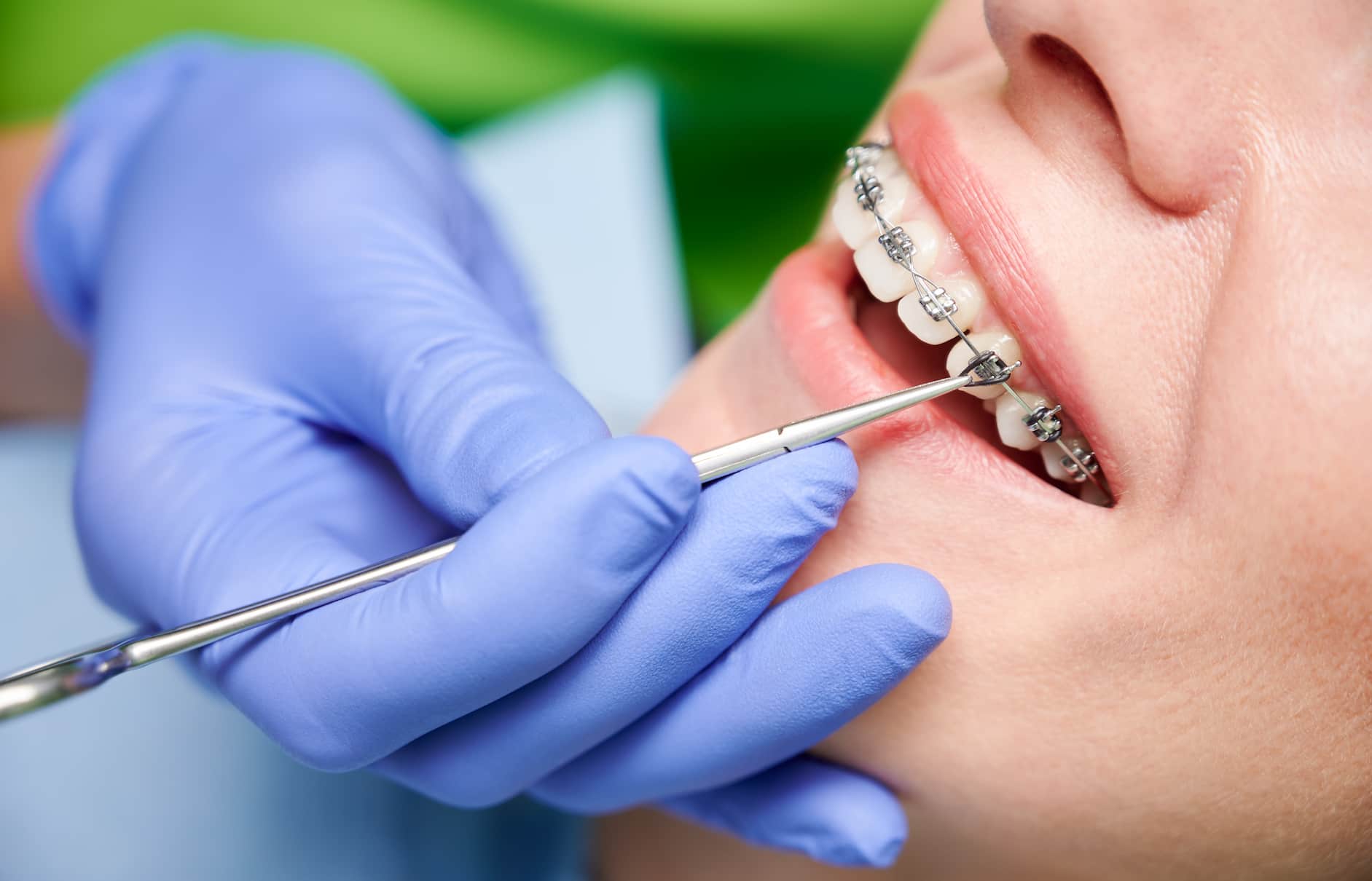 Traitement orthodontique en turquie
