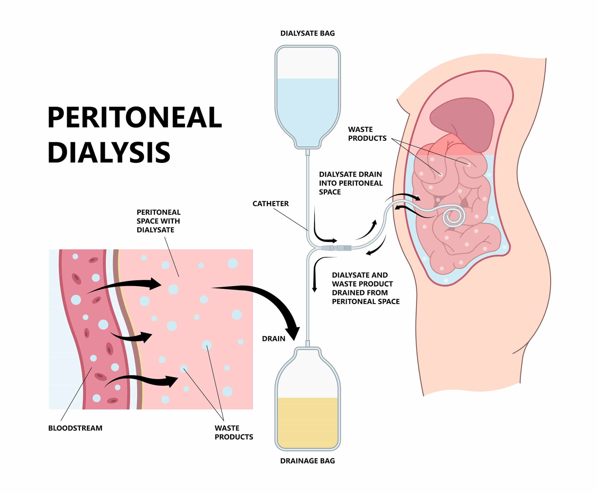 Peritoneal dialysis turkiye