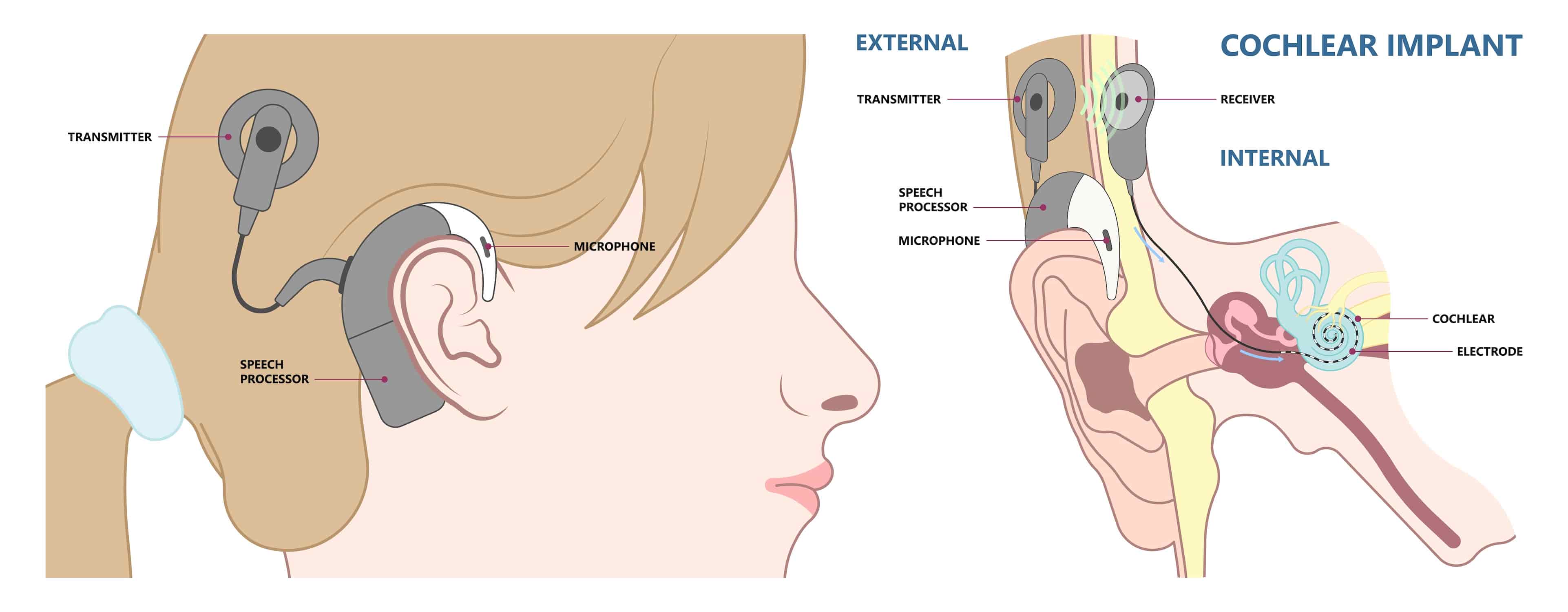 Turkiye cochlear implant